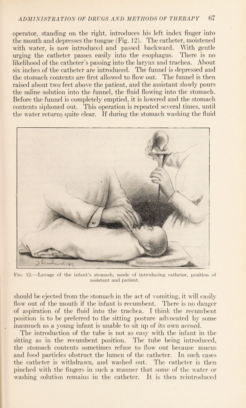operator, standing on the right, introduces his left index finger into the mouth and depresses the tongue (Fig. 12). The catheter, moistened with wTater, is now introduced and passed backward. With gentle urging the catheter passes easily into the esophagus. There is no likelihood of the catheter’s passing into the larynx and trachea. About six inches of the catheter are introduced. The funnel is depressed and the stomach contents are first allowed to flow out. The funnel is then raised about two feet above the patient, and the assistant slowly pours the saline solution into the funnel, the fluid flowing into the stomach. Before the funnel is completely emptied, it is lowered and the stomach contents siphoned out. This operation is repeated several times, until the water returns quite clear. If during the stomach washing the fluid Fig. 12.—Lavage of the infant’s stomach, mode of introducing catheter, position of assistant and patient. should be ejected from the stomach in the act of vomiting, it will easily flow out of the mouth if the infant is recumbent. There is no danger of aspiration of the fluid into the trachea. I think the recumbent position is to be preferred to the sitting posture advocated by some inasmuch as a young infant is unable to sit up of its own accord. The introduction of the tube is not as easy with the infant in the sitting as in the recumbent position. The tube being introduced, the stomach contents sometimes refuse to flow out because mucus and food particles obstruct the lumen of the catheter. In such cases the catheter is withdrawn, and washed out. The catheter is then pinched with the fingers in such a manner that some of the water or washing solution remains in the catheter. It is then reintroduced