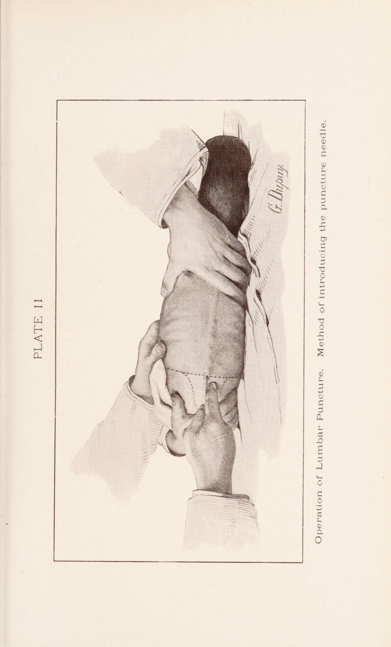 PLATE II Operation of Lumbar Puncture. Method of introducing the puncture needle.