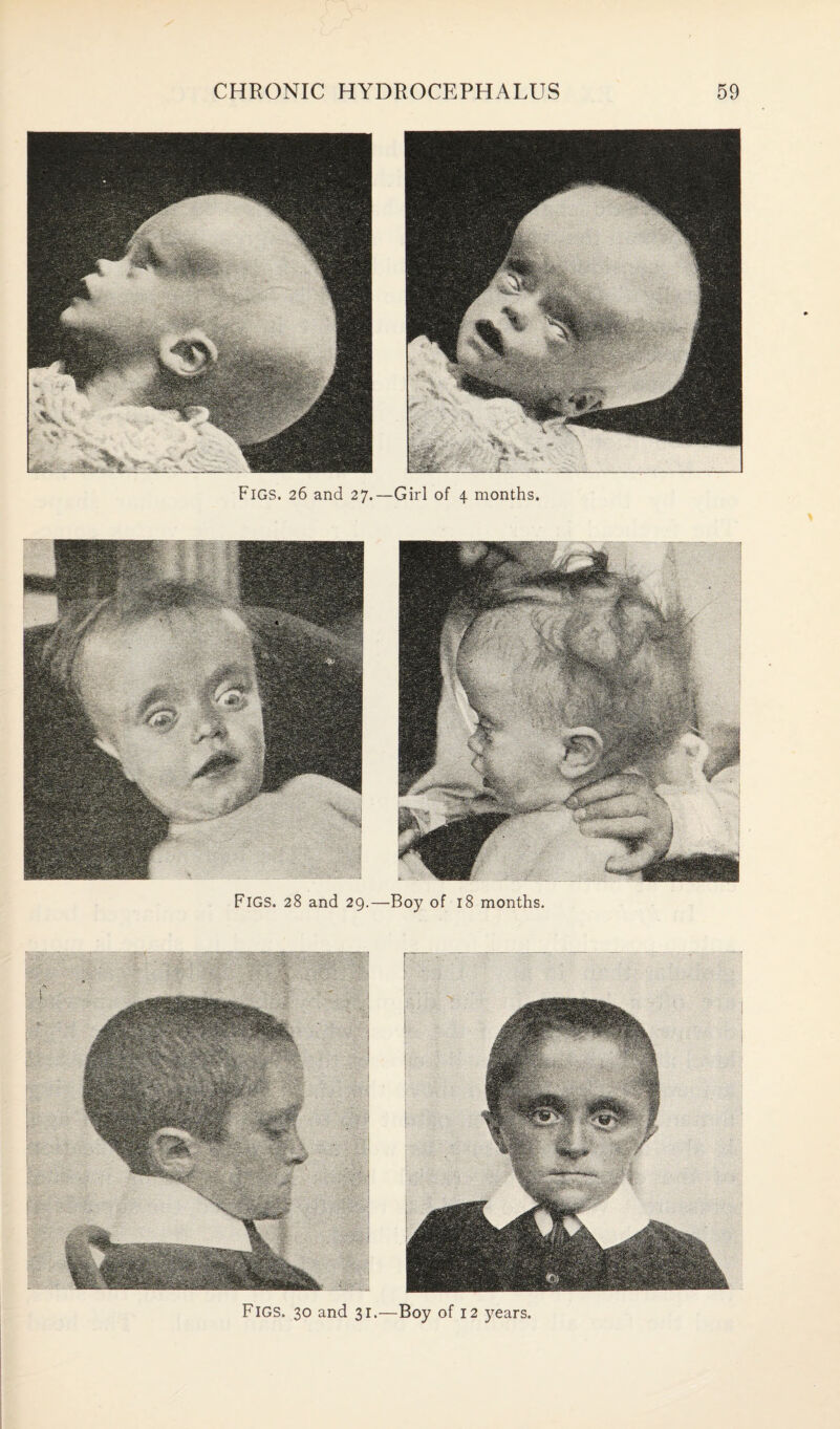 Figs. 26 and 27.—Girl of 4 months. Figs. 28 and 29.—Boy of 18 months. Figs. 30 and 31.—Boy of 12 years.