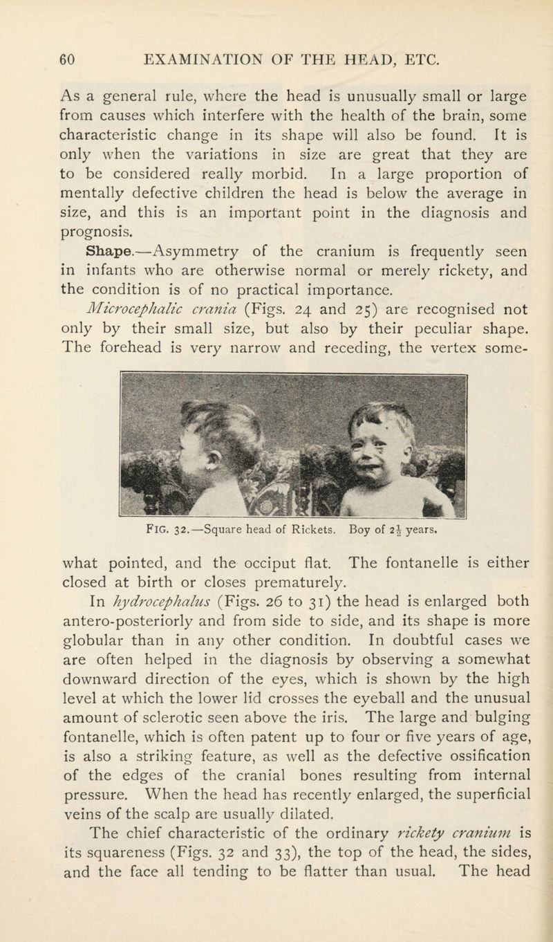 As a general rule, where the head is unusually small or large from causes which interfere with the health of the brain, some characteristic change in its shape will also be found. It is only when the variations in size are great that they are to be considered really morbid. In a large proportion of mentally defective children the head is below the average in size, and this is an important point in the diagnosis and prognosis. Shape.—Asymmetry of the cranium is frequently seen in infants who are otherwise normal or merely rickety, and the condition is of no practical importance. Microcephalic crania (Figs. 24 and 25) are recognised not only by their small size, but also by their peculiar shape. The forehead is very narrow and receding, the vertex some- FlG. 32.—Square head of Rickets. Boy of 2| years. what pointed, and the occiput flat. The fontanelle is either closed at birth or closes prematurely. In hydrocephalus (Figs. 26 to 31) the head is enlarged both antero-posteriorly and from side to side, and its shape is more globular than in any other condition. In doubtful cases we are often helped in the diagnosis by observing a somewhat downward direction of the eyes, which is shown by the high level at which the lower lid crosses the eyeball and the unusual amount of sclerotic seen above the iris. The large and bulging fontanelle, which is often patent up to four or five years of age, is also a striking feature, as well as the defective ossification of the edges of the cranial bones resulting from internal pressure. When the head has recently enlarged, the superficial veins of the scalp are usually dilated. The chief characteristic of the ordinary rickety cranium is its squareness (Figs. 32 and 33), the top of the head, the sides, and the face all tending to be flatter than usual. The head