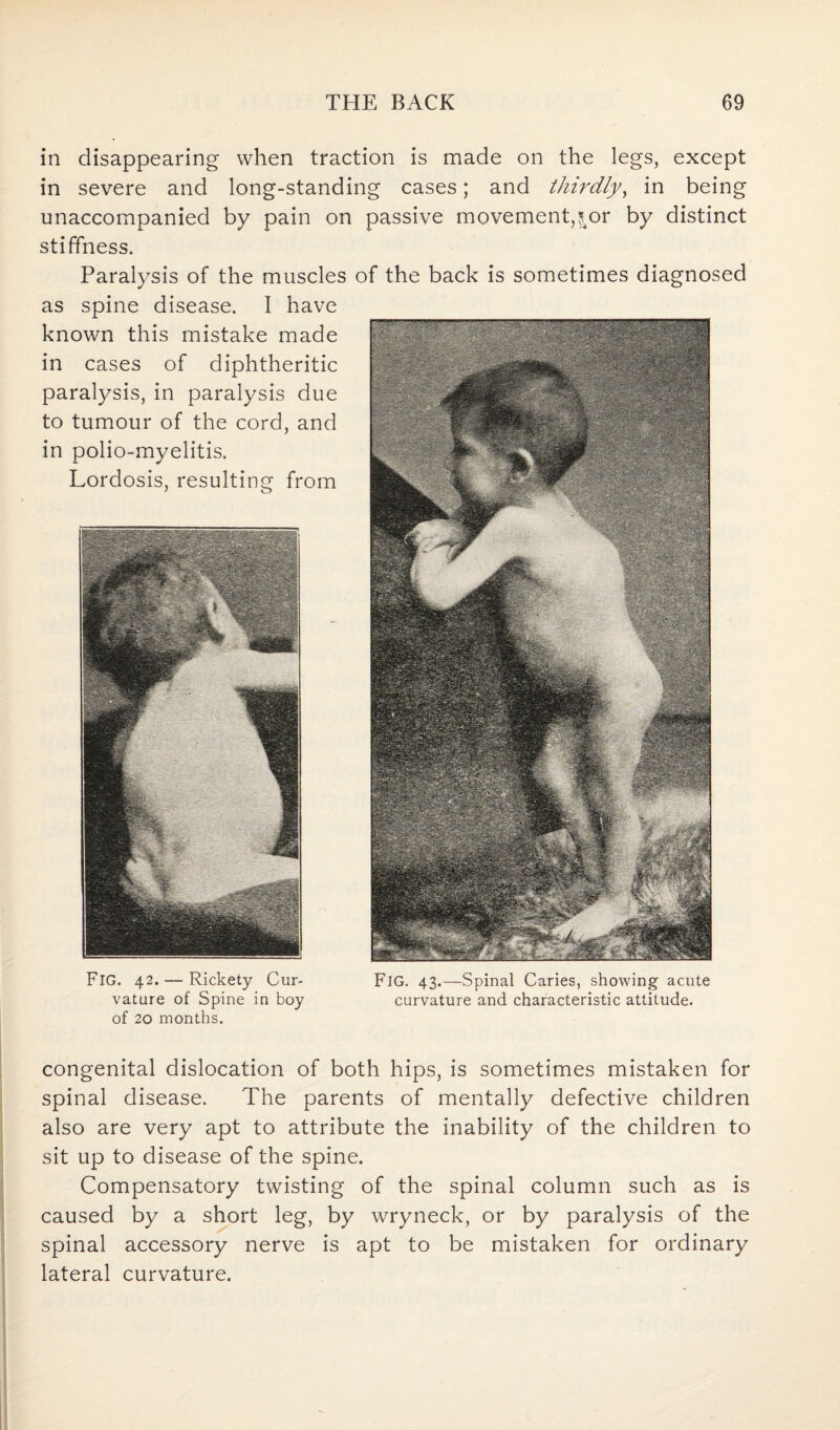 in disappearing when traction is made on the legs, except in severe and long-standing cases; and thirdly, in being unaccompanied by pain on passive movement,$or by distinct stiffness. Paralysis of the muscles of the back is sometimes diagnosed as spine disease. I have known this mistake made in cases of diphtheritic paralysis, in paralysis due to tumour of the cord, and in polio-myelitis. Lordosis, resulting from FlG. 42. — Rickety Cur¬ vature of Spine in boy of 20 months. congenital dislocation of both hips, is sometimes mistaken for spinal disease. The parents of mentally defective children also are very apt to attribute the inability of the children to sit up to disease of the spine. Compensatory twisting of the spinal column such as is caused by a short leg, by wryneck, or by paralysis of the spinal accessory nerve is apt to be mistaken for ordinary lateral curvature. Fig. 43.—Spinal Caries, showing acute curvature and characteristic attitude.