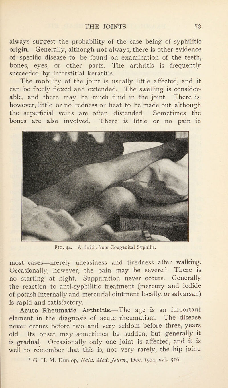 always suggest the probability of the case being of syphilitic origin. Generally, although not always, there is other evidence of specific disease to be found on examination of the teeth, bones, eyes, or other parts. The arthritis is frequently succeeded by interstitial keratitis. The mobility of the joint is usually little affected, and it can be freely flexed and extended. The swelling is consider¬ able, and there may be much fluid in the joint. There is however, little or no redness or heat to be made out, although the superficial veins are often distended. Sometimes the bones are also involved. There is little or no pain in FlG. 44.—Arthritis from Congenital Syphilis. most cases—merely uneasiness and tiredness after walking. Occasionally, however, the pain may be severe.1 There is no starting at night. Suppuration never occurs. Generally the reaction to anti-syphilitic treatment (mercury and iodide of potash internally and mercurial ointment locally, or salvarsan) is rapid and satisfactory. Acute Rheumatic Arthritis.—The age is an important element in the diagnosis of acute rheumatism. The disease never occurs before two, and very seldom before three, years old. Its onset may sometimes be sudden, but generally it is gradual. Occasionally only one joint is affected, and it is well to remember that this is, not very rarely, the hip joint. G. H. M. Dunlop, Edin. Med. Journ., Dec. 1904, xvi., 516. 1