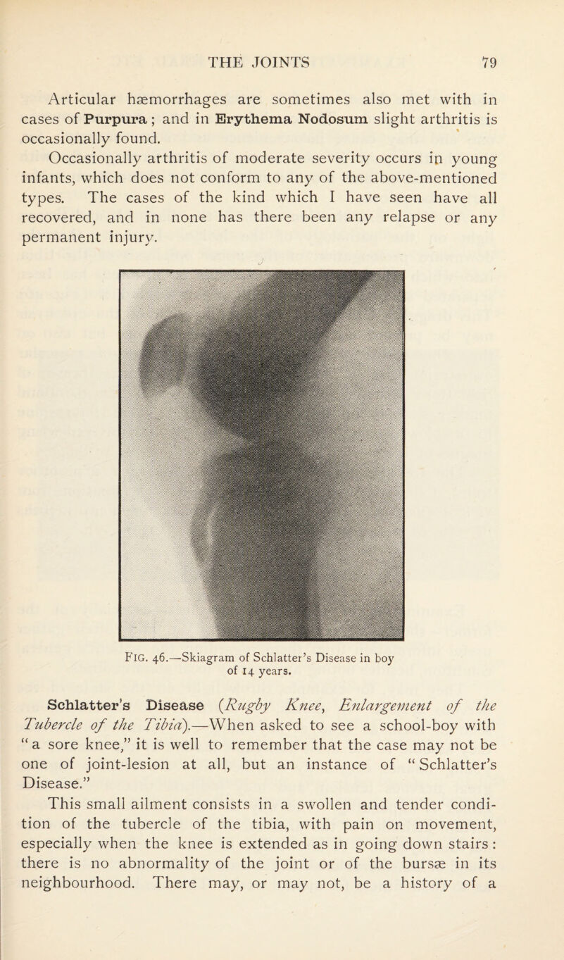 Articular haemorrhages are sometimes also met with in cases of Purpura; and in Erythema Nodosum slight arthritis is occasionally found. Occasionally arthritis of moderate severity occurs in young infants, which does not conform to any of the above-mentioned types. The cases of the kind which I have seen have all recovered, and in none has there been any relapse or any permanent injury. j Fig. 46.—-Skiagram of Schlatter’s Disease in boy of 14 years. Schlatter’s Disease {Rugby Knee, Enlargement of the Tubercle of the Tibia).—When asked to see a school-boy with “ a sore knee,” it is well to remember that the case may not be one of joint-lesion at all, but an instance of “ Schlatter’s Disease.” This small ailment consists in a swollen and tender condi¬ tion of the tubercle of the tibia, with pain on movement, especially when the knee is extended as in going down stairs : there is no abnormality of the joint or of the bursae in its neighbourhood. There may, or may not, be a history of a