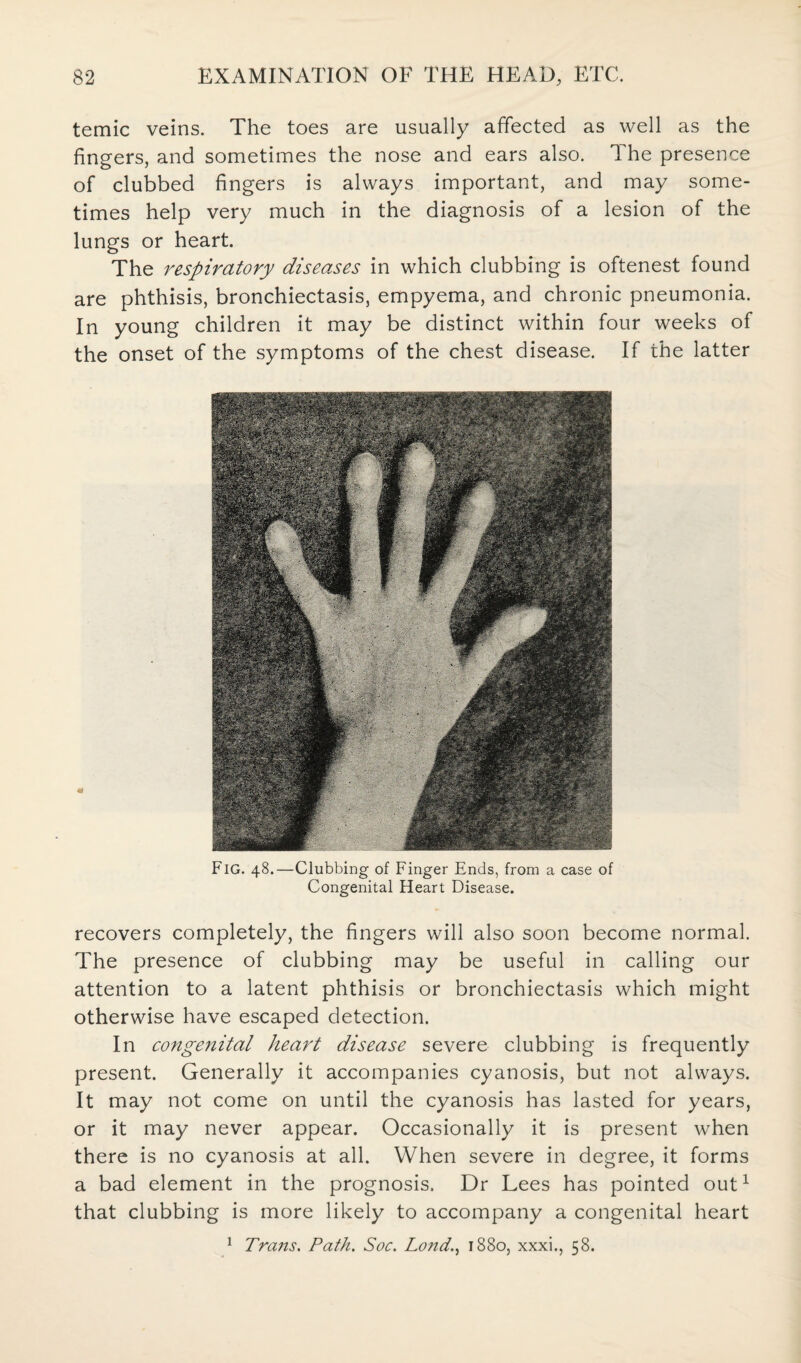 temic veins. The toes are usually affected as well as the fingers, and sometimes the nose and ears also. The presence of clubbed fingers is always important, and may some¬ times help very much in the diagnosis of a lesion of the lungs or heart. The respiratory diseases in which clubbing is oftenest found are phthisis, bronchiectasis, empyema, and chronic pneumonia. In young children it may be distinct within four weeks of the onset of the symptoms of the chest disease. If the latter FlG. 48.—Clubbing of Finger Ends, from a case of Congenital Heart Disease. recovers completely, the fingers will also soon become normal. The presence of clubbing may be useful in calling our attention to a latent phthisis or bronchiectasis which might otherwise have escaped detection. In congenital heart disease severe clubbing is frequently present. Generally it accompanies cyanosis, but not always. It may not come on until the cyanosis has lasted for years, or it may never appear. Occasionally it is present when there is no cyanosis at all. When severe in degree, it forms a bad element in the prognosis. Dr Lees has pointed out1 that clubbing is more likely to accompany a congenital heart 1 Trans. Path. Soc. Lo?idn 1880, xxxi., 58.