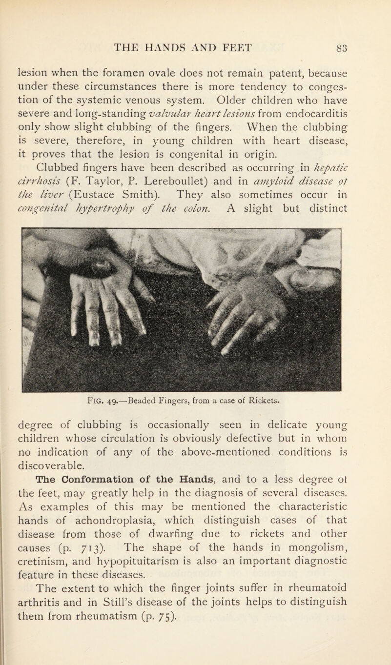 lesion when the foramen ovale does not remain patent, because under these circumstances there is more tendency to conges¬ tion of the systemic venous system. Older children who have severe and long-standing valvular heart lesions from endocarditis only show slight clubbing of the fingers. When the clubbing is severe, therefore, in young children with heart disease, it proves that the lesion is congenital in origin. Clubbed fingers have been described as occurring in hepatic cirrhosis (F. Taylor, P. Lereboullet) and in amyloid disease of the liver (Eustace Smith). They also sometimes occur in congenital hypertrophy of the colon. A slight but distinct Fig. 49.—Beaded Fingers, from a case of Rickets. degree of clubbing is occasionally seen in delicate young children whose circulation is obviously defective but in whom no indication of any of the above-mentioned conditions is discoverable. The Conformation of the Hands, and to a less degree ot the feet, may greatly help in the diagnosis of several diseases. As examples of this may be mentioned the characteristic hands of achondroplasia, which distinguish cases of that disease from those of dwarfing due to rickets and other causes (p. 713). The shape of the hands in mongolism, cretinism, and hypopituitarism is also an important diagnostic feature in these diseases. The extent to which the finger joints suffer in rheumatoid arthritis and in Still’s disease of the joints helps to distinguish them from rheumatism (p. 75).