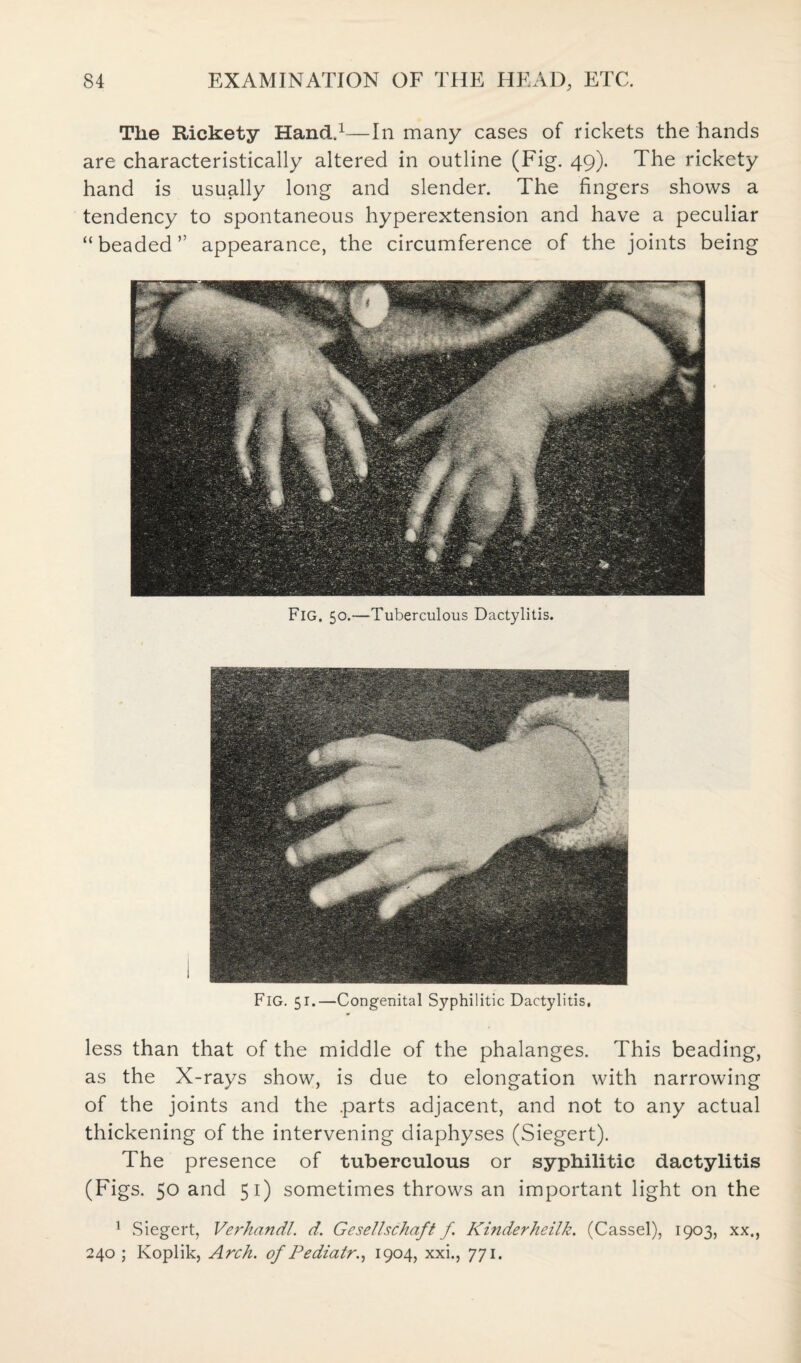 The Rickety Hand.1—In many cases of rickets the hands are characteristically altered in outline (Fig. 49). The rickety hand is usually long and slender. The fingers shows a tendency to spontaneous hyperextension and have a peculiar “beaded” appearance, the circumference of the joints being Fig, 50.—Tuberculous Dactylitis. Fig. 51.—Congenital Syphilitic Dactylitis, less than that of the middle of the phalanges. This beading, as the X-rays show, is due to elongation with narrowing of the joints and the parts adjacent, and not to any actual thickening of the intervening diaphyses (Siegert). The presence of tuberculous or syphilitic dactylitis (Figs. 50 and 51) sometimes throws an important light on the 1 Siegert, Verhandl. d. Gcsellschaft f Kinderheilk. (Cassel), 1903, xx., 240 ; Koplik, Arch, of Pediatr., 1904, xxi., 771.