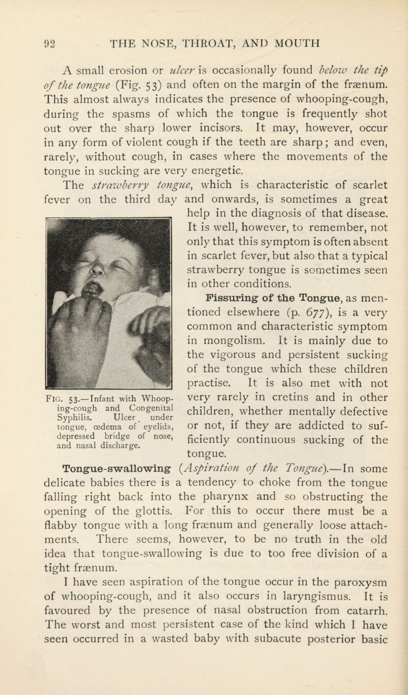 A small erosion or ulcer is occasionally found beloiv the tip of the tongue (Fig. 53) and often on the margin of the frsenum. This almost always indicates the presence of whooping-cough, during the spasms of which the tongue is frequently shot out over the sharp lower incisors. It may, however, occur in any form of violent cough if the teeth are sharp; and even, rarely, without cough, in cases where the movements of the tongue in sucking are very energetic. The strawberry tongue, which is characteristic of scarlet fever on the third day and onwards, is sometimes a great help in the diagnosis of that disease. It is well, however, to remember, not only that this symptom is often absent in scarlet fever, but also that a typical strawberry tongue is sometimes seen in other conditions. Fissuring of the Tongue, as men¬ tioned elsewhere (p. 677), is a very common and characteristic symptom in mongolism. It is mainly due to the vigorous and persistent sucking of the tongue which these children practise. It is also met with not very rarely in cretins and in other children, whether mentally defective or not, if they are addicted to suf¬ ficiently continuous sucking of the tongue. Tongue-swallowing (Aspiration of the Tongue').— In some delicate babies there is a tendency to choke from the tongue falling right back into the pharynx and so obstructing the opening of the glottis. For this to occur there must be a flabby tongue with a long fraenum and generally loose attach¬ ments. There seems, however, to be no truth in the old idea that tongue-swallowing is due to too free division of a tight fraenum. I have seen aspiration of the tongue occur in the paroxysm of whooping-cough, and it also occurs in laryngismus. It is favoured by the presence of nasal obstruction from catarrh. The worst and most persistent case of the kind which I have seen occurred in a wasted baby with subacute posterior basic Fig. 53.—Infant with Whoop¬ ing-cough and Congenital Syphilis. Ulcer ^ under tongue, oedema of eyelids, depressed bridge of nose, and nasal discharge.