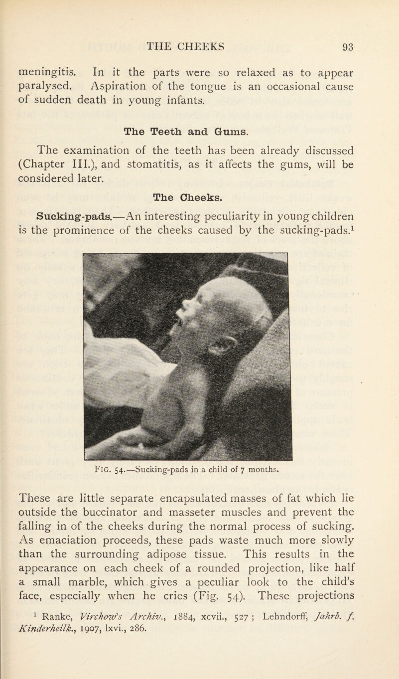 meningitis. In it the parts were so relaxed as to appear paralysed. Aspiration of the tongue is an occasional cause of sudden death in young infants. The Teeth and Gums. The examination of the teeth has been already discussed (Chapter III.), and stomatitis, as it affects the gums, will be considered later. The Cheeks. Sucking-pads.—An interesting peculiarity in young children is the prominence of the cheeks caused by the sucking-pads.1 Fig. 54.—Sucking-pads in a child of 7 months. These are little separate encapsulated masses of fat which lie outside the buccinator and masseter muscles and prevent the falling in of the cheeks during the normal process of sucking. As emaciation proceeds, these pads waste much more slowly than the surrounding adipose tissue. This results in the appearance on each cheek of a rounded projection, like half a small marble, which gives a peculiar look to the child’s face, especially when he cries (Fig. 54). These projections 1 Ranke, Virchow’s Archiv., 1884, xcvii., 527 ; Lehndorff, Jahrb. f Kinderheilk., 1907, lxvi., 286.