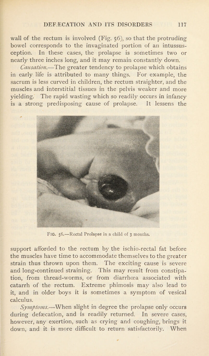 wall of the rectum is involved (Fig. 56), so that the protruding bowel corresponds to the invaginated portion of an intussus¬ ception. In these cases, the prolapse is sometimes two or nearly three inches long, and it may remain constantly down. Causation.—The greater tendency to prolapse which obtains in early life is attributed to many things. For example, the sacrum is less curved in children, the rectum straighter, and the muscles and interstitial tissues in the pelvis weaker and more yielding. The rapid wasting which so readily occurs in infancy is a strong predisposing cause of prolapse. It lessens the Fig. 56.—Rectal Prolapse in a child of 3 months. support afforded to the rectum by the ischio-rectal fat before the muscles have time to accommodate themselves to the greater strain thus thrown upon them. The exciting cause is severe and long-continued straining. This may result from constipa¬ tion, from thread-worms, or from diarrhoea associated with catarrh of the rectum. Extreme phimosis may also lead to it, and in older boys it is sometimes a symptom of vesical calculus. Symptoms.—When slight in degree the prolapse only occurs during defsecation, and is readily returned. In severe cases, however, any exertion, such as crying and coughing, brings it down, and it is more difficult to return satisfactorily. When