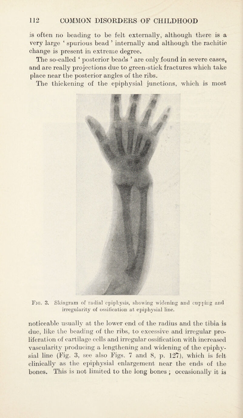 is often no beading to be felt externally, although there is a very large ‘ spurious bead ’ internally and although the rachitic change is present in extreme degree. The so-called ‘ posterior beads ’ are only found in severe cases, and are really projections due to green-stick fractures which take place near the posterior angles of the ribs. The thickening of the epiphysial junctions, which is most Fig. 3. Skiagram of radial epiphysis, showing widening and cupping and irregularity of ossification at epiphysial line. noticeable usually at the lower end of the radius and the tibia is due, like the beading of the ribs, to excessive and irregular pro¬ liferation of cartilage cells and irregular ossification with increased vascularit}/- producing a lengthening and widening of the epiphy¬ sial line (Fig. 3, see also Figs. 7 and 8, p. 127), which is felt clinically as the epiphysial enlargement near the ends of the bones. This is not limited to the long bones ; occasionally it is