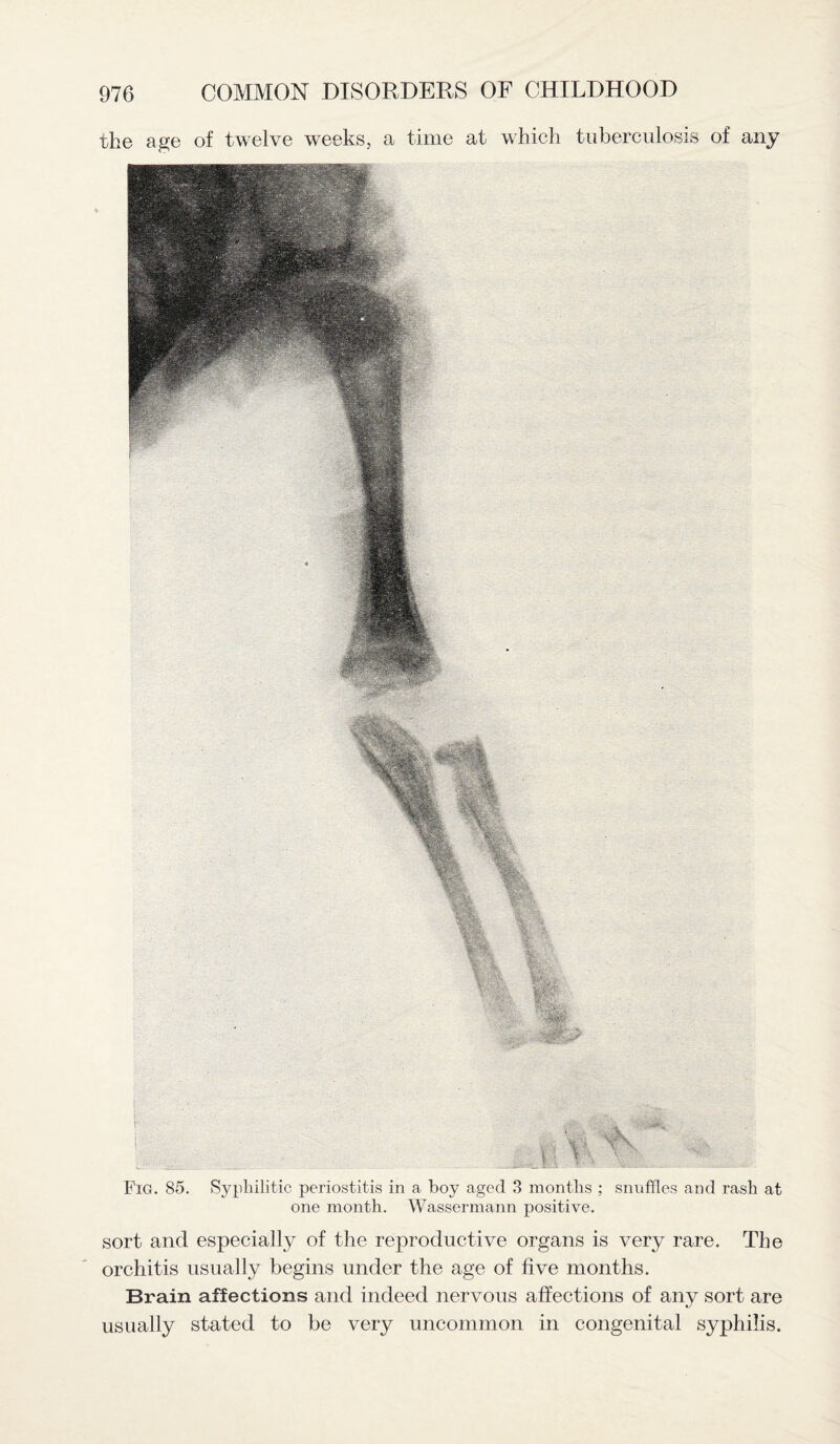 the age of twelve weeks, a time at which tuberculosis of any Fig. 85. Syphilitic periostitis in a boy aged 3 months ; snuffles and rash at one month. Wassermann positive. sort and especially of the reproductive organs is very rare. The orchitis usually begins under the age of five months. Brain affections and indeed nervous affections of any sort are usually stated to be very uncommon in congenital syphilis.