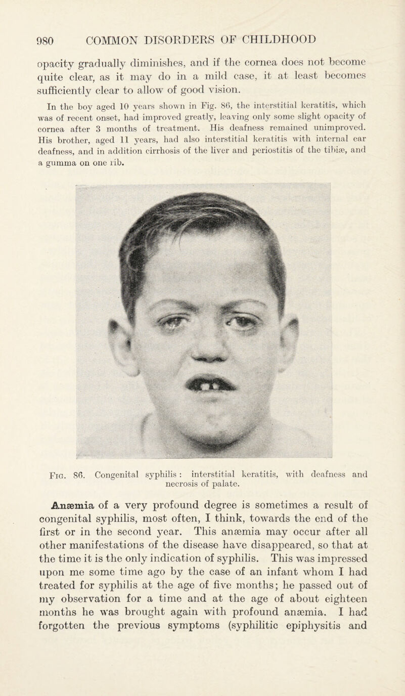 opacity gradually diminishes, and if the cornea does not become quite clear, as it may do in a mild case, it at least becomes sufficiently clear to allow of good vision. In the boy aged 10 years shown in Fig. 86, the interstitial keratitis, which was of recent onset, had improved greatly, leaving only some slight opacity of cornea after 3 months of treatment. His deafness remained unimproved. His brother, aged 11 years, had also interstitial keratitis with internal ear deafness, and in addition cirrhosis of the liver and periostitis of the tibise, and a gumma on one rib. Fig. 86. Congenital syphilis : interstitial keratitis, with deafness and necrosis of palate. Anaemia of a very profound degree is sometimes a result of congenital syphilis, most often, I think, towards the end of the first or in the second year. This anaemia may occur after all other manifestations of the disease have disappeared, so that at the time it is the only indication of syphilis. This was impressed upon me some time ago by the case of an infant whom I had treated for syphilis at the age of five months; he passed out of my observation for a time and at the age of about eighteen months he was brought again with profound anaemia. I had forgotten the previous symptoms (syphilitic epiphysitis and