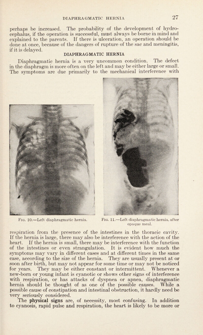 perhaps be increased. The probability of the development of hydro¬ cephalus, if the operation is successful, must always be borne in mind and explained to the parents. If there is ulceration, an operation should be done at once, because of the dangers of rupture of the sac and meningitis, if it is delayed. DIAPHRAGMATIC HERNIA Diaphragmatic hernia is a very uncommon condition. The defect in the diaphragm is more often on the left and may be either large or small. The symptoms are due primarily to the mechanical interference with Fig. 10.—Left diaphragmatic hernia. Fig. 11.—Left diaphragmatic hernia, after opaque meal. respiration from the presence of the intestines in the thoracic cavity. If the hernia is large, there may also be interference with the action of the heart. If the hernia is small, there may be interference with the function of the intestines or even strangulation. It is evident how much the symptoms may vary in different cases and at different times in the same case, according to the size of the hernia. They are usually present at or soon after birth, but may not appear for some time or may not be noticed for years. They may be either constant or intermittent. Whenever a new-born or young infant is cyanotic or shows other signs of interference with respiration, or has attacks of dyspnea or apnea, diaphragmatic hernia should be thought of as one of the possible causes. While a possible cause of constipation and intestinal obstruction, it hardly need be very seriously considered. The physical signs are, of necessity, most confusing. In addition to cyanosis, rapid pulse and respiration, the heart is likely to be more or