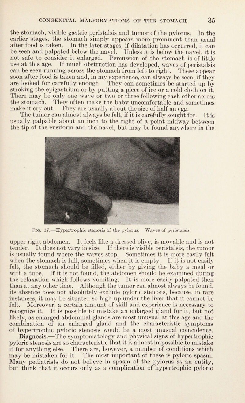 the stomach, visible gastric peristalsis and tumor of the pylorus. In the earlier stages, the stomach simply appears more prominent than usual after food is taken. In the later stages, if dilatation has occurred, it can be seen and palpated below the navel. Unless it is below the navel, it is not safe to consider it enlarged. Percussion of the stomach is of little use at this age. If much obstruction has developed, waves of peristalsis can be seen running across the stomach from left to right. These appear soon after food is taken and, in my experience, can always be seen, if they are looked for carefully enough. They can sometimes be started up by stroking the epigastrium or by putting a piece of ice or a cold cloth on it. There may be only one wave or two or three following each other across the stomach. They often make the baby uncomfortable and sometimes make it cry out. They are usually about the size of half an egg. The tumor can almost always be felt, if it is carefully sought for. It is usually palpable about an inch to the right of a point midway between the tip of the ensiform and the navel, but may be found anywhere in the Fig. 17.—Hypertrophic stenosis of the pylorus. Waves of peristalsis. upper right abdomen. It feels like a dressed olive, is movable and is not tender. It does not vary in size. If there is visible peristalsis, the tumor is usually found where the waves stop. Sometimes it is more easily felt when the stomach is full, sometimes when it is empty. If it is not easily felt, the stomach should be filled, either by giving the baby a meal or with a tube. If it is not found, the abdomen should be examined during the relaxation which follows vomiting. It is more easily palpated then than at any other time. Although the tumor can almost always be found, its absence does not absolutely exclude pyloric stenosis, because, in rare instances, it may be situated so high up under the liver that it cannot be felt. Moreover, a certain amount of skill and experience is necessary to recognize it. It is possible to mistake an enlarged gland for it, but not likely, as enlarged abdominal glands are most unusual at this age and the combination of an enlarged gland and the characteristic symptoms of hypertrophic pyloric stenosis would be a most unusual coincidence. Diagnosis.—The symptomatology and physical signs of hypertrophic pyloric stenosis are so characteristic that it is almost impossible to mistake it for anything else. There are, however, a number of conditions which may be mistaken for it. The most important of these is pyloric spasm. Many pediatrists do not believe in spasm of the pylorus as an entity, but think that it occurs only as a complication of hypertrophic pyloric