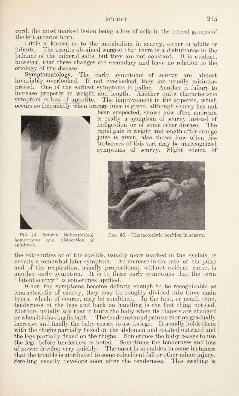 cord, the most marked lesion being a loss of cells in the lateral groups of the left anterior horn. Little is known as to the metabolism in scurvy, either in adults or infants. The results obtained suggest that there is a disturbance in the balance of the mineral salts, but they are not constant. It is evident, however, that these changes are secondary and have no relation to the etiology of the disease. Symptomatology.—-The early symptoms of scurvy are almost invariably overlooked. If not overlooked, they are usually misinter¬ preted. One of the earliest symptoms is pallor. Another is failure to increase properly in weight and length. Another quite characteristic symptom is loss of appetite. The improvement in the appetite, which occurs so frequently when orange juice is given, although scurvy has not been suspected, shows how often anorexia is really a symptom of scurvy instead of indigestion or of some other disease. The rapid gain in weight and length after orange juice is given, also shows how often dis¬ turbances of this sort may be unrecognized symptoms of scurvy. Slight edema of Fig. 44.—Scurvy. Subperiosteal hemorrhage and dislocation of epiphysis. Fig. 45.—Characteristic position in scurvy. the extremities or of the eyelids, usually more marked in the eyelids, is usually a somewhat later symptom. An increase in the rate of the pulse and of the respiration, usually proportional, without evident cause, is another early symptom. It is to these early symptoms that the term “latent scurvy ” is sometimes applied. When the symptoms become definite enough to be recognizable as characteristic of scurvy, they may be roughly divided into three main types, which, of course, may be combined. In the first, or usual, type, tenderness of the legs and back on handling is the first thing noticed. Mothers usually say that it hurts the baby when its diapers are changed or when it is having its bath. The tenderness and pain on motion gradually increase, and finally the baby ceases to use its legs. It usually holds them with the thighs partially flexed on the abdomen and rotated outward and the legs partially flexed on the thighs. Sometimes the baby ceases to use the legs before tenderness is noted. Sometimes the tenderness and loss of power develop very quickly. The onset is so sudden in some instances that the trouble is attributed to some coincident fall or other minor injury. Swelling usually develops soon after the tenderness. This swelling is