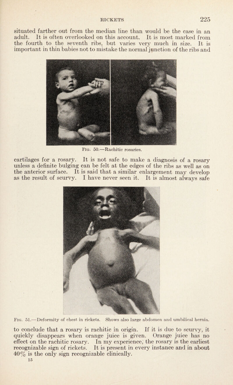 situated farther out from the median line than would be the case in an adult. It is often overlooked on this account. It is most marked from the fourth to the seventh ribs, but varies very much in size. It is important in thin babies not to mistake the normal junction of the ribs and Fig. 50.—Rachitic rosaries. cartilages for a rosary. It is not safe to make a diagnosis of a rosary unless a definite bulging can be felt at the edges of the ribs as well as on the anterior surface. It is said that a similar enlargement may develop as the result of scurvy. I have never seen it. It is almost always safe Fig. 51.—Deformity of chest in rickets. Shows also large abdomen and umbilical hernia. to conclude that a rosary is rachitic in origin. If it is due to scurvy, it quickly disappears when orange juice is given. Orange juice has no effect on the rachitic rosary. In my experience, the rosary is the earliest recognizable sign of rickets. It is present in every instance and in about 40% is the only sign recognizable clinically. 15