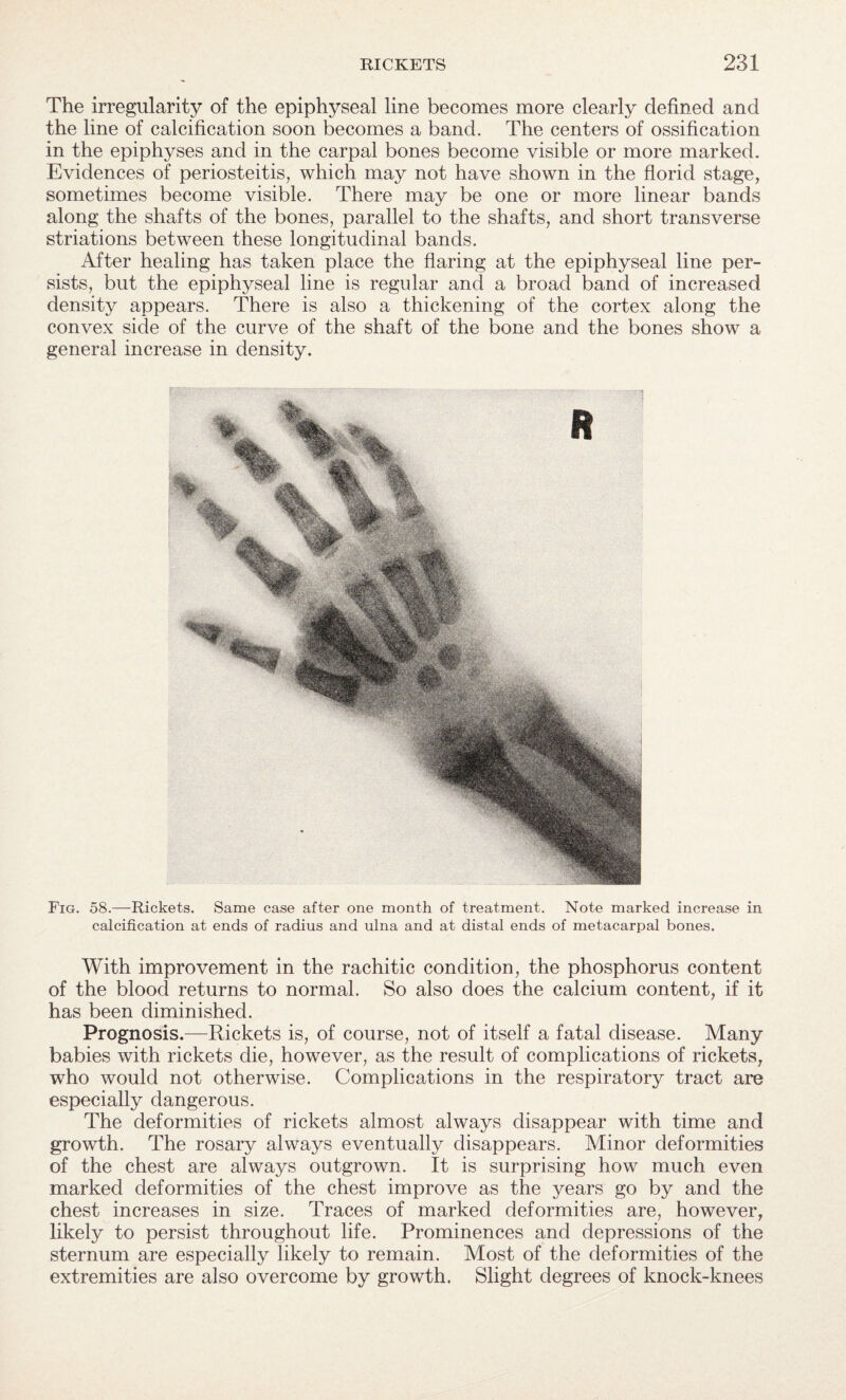 The irregularity of the epiphyseal line becomes more clearly defined and the line of calcification soon becomes a band. The centers of ossification in the epiphyses and in the carpal bones become visible or more marked. Evidences of periosteitis, which may not have shown in the florid stage, sometimes become visible. There may be one or more linear bands along the shafts of the bones, parallel to the shafts, and short transverse striations between these longitudinal bands. After healing has taken place the flaring at the epiphyseal line per¬ sists, but the epiphyseal line is regular and a broad band of increased density appears. There is also a thickening of the cortex along the convex side of the curve of the shaft of the bone and the bones show a general increase in density. Fig. 58.—Rickets. Same case after one month of treatment. Note marked increase in calcification at ends of radius and ulna and at distal ends of metacarpal bones. With improvement in the rachitic condition, the phosphorus content of the blood returns to normal. So also does the calcium content, if it has been diminished. Prognosis.—Rickets is, of course, not of itself a fatal disease. Many babies with rickets die, however, as the result of complications of rickets, who would not otherwise. Complications in the respiratory tract are especially dangerous. The deformities of rickets almost always disappear with time and growth. The rosary always eventually disappears. Minor deformities of the chest are always outgrown. It is surprising how much even marked deformities of the chest improve as the years go by and the chest increases in size. Traces of marked deformities are, however, likely to persist throughout life. Prominences and depressions of the sternum are especially likely to remain. Most of the deformities of the extremities are also overcome by growth. Slight degrees of knock-knees