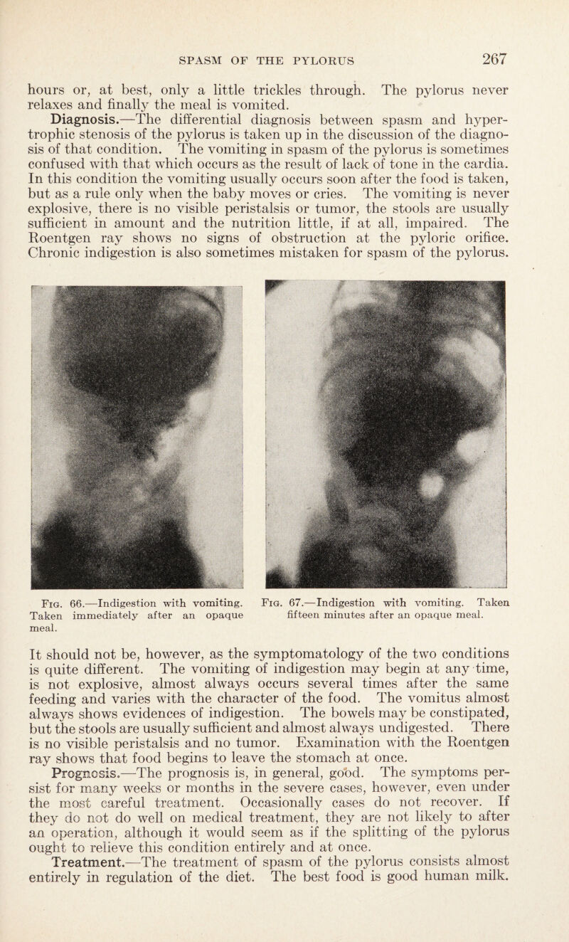 hours or, at best, only a little trickles through. The pylorus never relaxes and finally the meal is vomited. Diagnosis.—The differential diagnosis between spasm and hyper¬ trophic stenosis of the pylorus is taken up in the discussion of the diagno¬ sis of that condition. The vomiting in spasm of the pylorus is sometimes confused with that which occurs as the result of lack of tone in the cardia. In this condition the vomiting usually occurs soon after the food is taken, but as a rule only when the baby moves or cries. The vomiting is never explosive, there is no visible peristalsis or tumor, the stools are usually sufficient in amount and the nutrition little, if at all, impaired. The Roentgen ray shows no signs of obstruction at the pyloric orifice. Chronic indigestion is also sometimes mistaken for spasm of the pylorus. Fig. 66.—Indigestion with vomiting. Fig. 67.—Indigestion with vomiting. Taken Taken immediately after an opaque fifteen minutes after an opaque meal, meal. It should not be, however, as the symptomatology of the two conditions is quite different. The vomiting of indigestion may begin at any time, is not explosive, almost always occurs several times after the same feeding and varies with the character of the food. The vomitus almost always shows evidences of indigestion. The bowels may be constipated, but the stools are usually sufficient and almost always undigested. There is no visible peristalsis and no tumor. Examination with the Roentgen ray shows that food begins to leave the stomach at once. Prognosis.—The prognosis is, in general, good. The symptoms per¬ sist for many weeks or months in the severe cases, however, even under the most careful treatment. Occasionally cases do not recover. If they do not do well on medical treatment, they are not likely to after an operation, although it would seem as if the splitting of the pylorus ought to relieve this condition entirely and at once. Treatment.—The treatment of spasm of the pylorus consists almost entirely in regulation of the diet. The best food is good human milk.