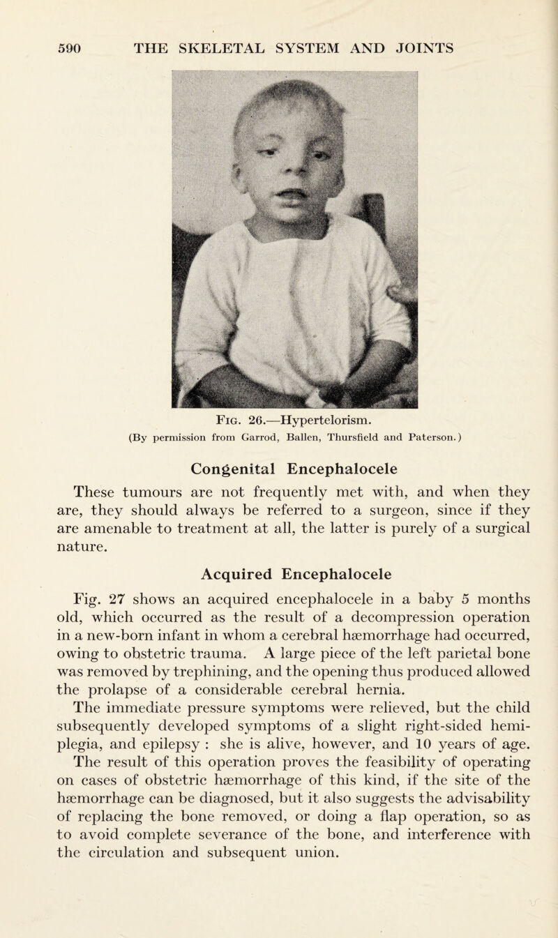 Fig. 26.—Hypertelorism. (By permission from Garrod, Ballen, Thursfield and Paterson.) Congenital Encephalocele These tumours are not frequently met with, and when they are, they should always be referred to a surgeon, since if they are amenable to treatment at all, the latter is purely of a surgical nature. Acquired Encephalocele Fig. 27 shows an acquired encephalocele in a baby 5 months old, which occurred as the result of a decompression operation in a new-born infant in whom a cerebral haemorrhage had occurred, owing to obstetric trauma. A large piece of the left parietal bone was removed by trephining, and the opening thus produced allowed the prolapse of a considerable cerebral hernia. The immediate pressure symptoms were relieved, but the child subsequently developed symptoms of a slight right-sided hemi¬ plegia, and epilepsy : she is alive, however, and 10 years of age. The result of this operation proves the feasibility of operating on cases of obstetric haemorrhage of this kind, if the site of the haemorrhage can be diagnosed, but it also suggests the advisability of replacing the bone removed, or doing a flap operation, so as to avoid complete severance of the bone, and interference with the circulation and subsequent union.