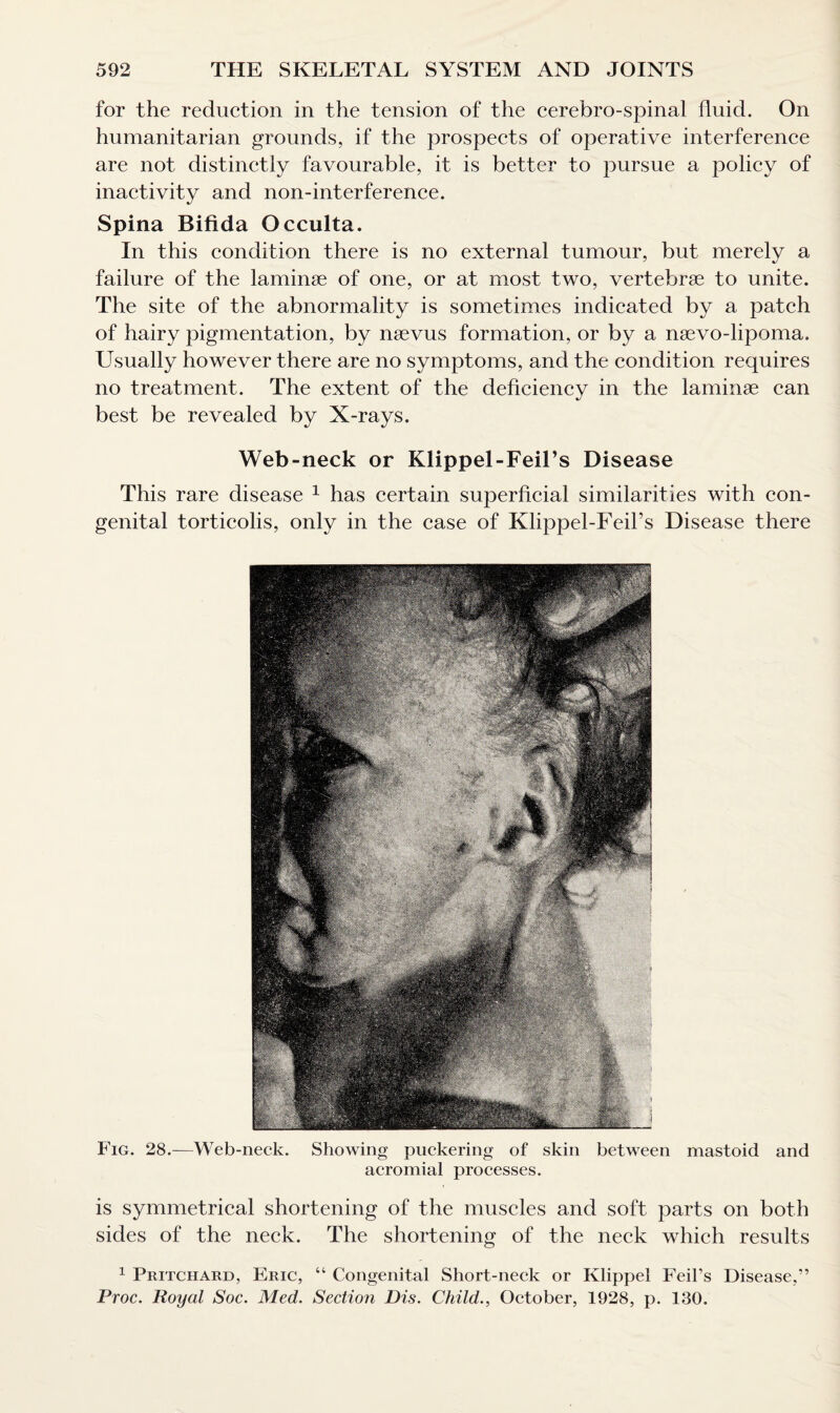 for the reduction in the tension of the cerebro-spinal fluid. On humanitarian grounds, if the prospects of operative interference are not distinctly favourable, it is better to pursue a policy of inactivity and non-interference. Spina Bifida Occulta. In this condition there is no external tumour, but merely a failure of the laminae of one, or at most two, vertebrae to unite. The site of the abnormality is sometimes indicated by a patch of hairy pigmentation, by naevus formation, or by a naevo-lipoma. Usually however there are no symptoms, and the condition requires no treatment. The extent of the deficiency in the laminae can best be revealed by X-rays. Web-neck or Klippel-Feil’s Disease This rare disease 1 has certain superficial similarities with con¬ genital torticolis, only in the case of Klippel-FeiPs Disease there Fig. 28.—Web-neck. Showing puckering of skin between mastoid and acromial processes. is symmetrical shortening of the muscles and soft parts on both sides of the neck. The shortening of the neck which results 1 Pritchard, Eric, “ Congenital Short-neck or Klippel Feil’s Disease,” Proc. Royal Soc. Med. Section Dis. Child., October, 1928, p. 130.