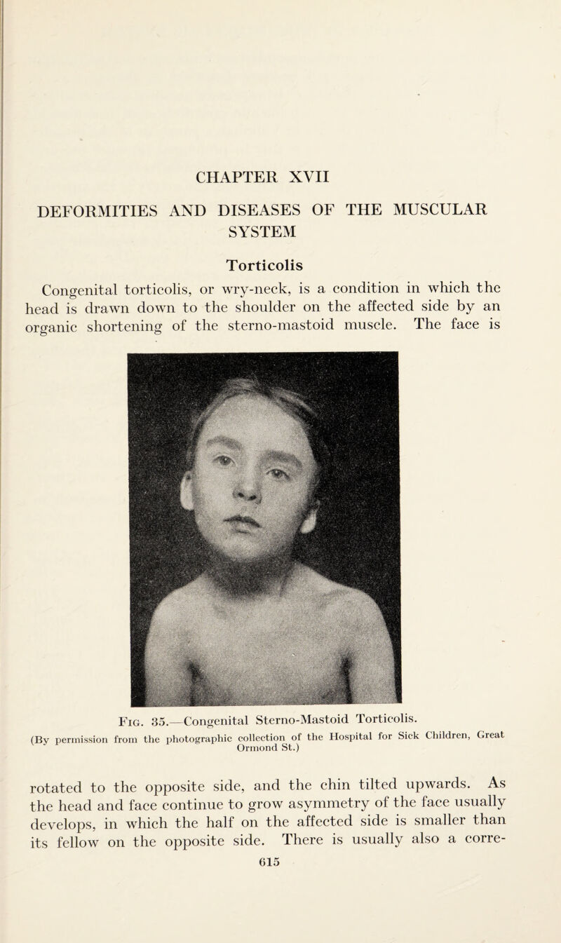 CHAPTER XVII DEFORMITIES AND DISEASES OF THE MUSCULAR SYSTEM Torticolis Congenital torticolis, or wry-neck, is a condition in which the head is drawn down to the shoulder on the affected side by an organic shortening of the sterno-mastoid muscle. The face is Fig. 35.—Congenital Sterno-Mastoid Torticolis. (By permission from the photographic collection of the Hospital for Sick Children, Great Ormond St.) rotated to the opposite side, and the chin tilted upwards. As the head and face continue to grow asymmetry of the face usually develops, in which the half on the affected side is smaller than its fellow on the opposite side. There is usually also a corre¬ cts