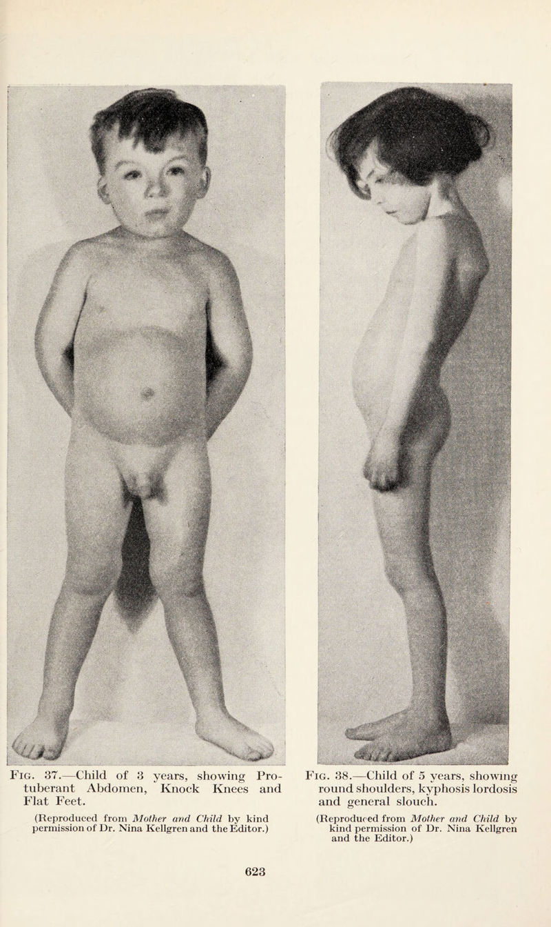 Fig. 37.—Child of 3 years, showing Pro¬ tuberant Abdomen, Knock Knees and Flat Feet. (Reproduced from Mother and Child by kind permission of Dr. Nina Kellgrenand the Editor.) Fig. 38.—Child of 5 vears, showing •s 7 O round shoulders, kyphosis lordosis and general slouch. (Reproduced from Mother and Child by kind permission of Dr. Nina Kellgren and the Editor.)