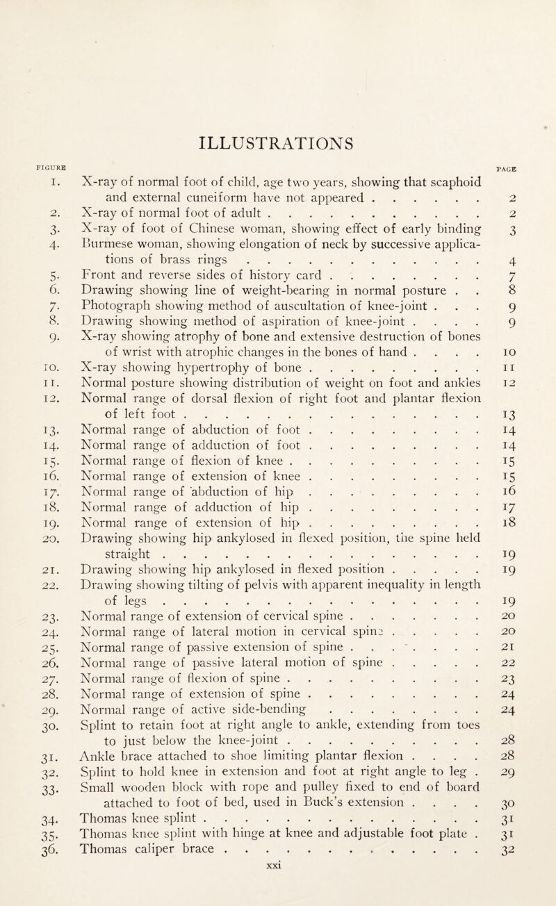 FIGURE PAGE 1. X-ray of normal foot of child, age two years, showing that scaphoid and external cuneiform have not appeared. 2 2. X-ray of normal foot of adult. 2 3. X-ray of foot of Chinese woman, showing effect of early binding 3 4. Burmese woman, showing elongation of neck by successive applica¬ tions of brass rings. 4 5. Front and reverse sides of history card. 7 6. Drawing showing line of weight-bearing in normal posture . . 8 7. Photograph showing method of auscultation of knee-joint ... 9 8. Drawing showing method of aspiration of knee-joint .... 9 9. X-ray showing atrophy of bone and extensive destruction of bones of wrist with atrophic changes in the bones of hand .... 10 10. X-ray showing hypertrophy of bone.11 11. Normal posture showing distribution of weight on foot and ankles 12 12. Normal range of dorsal flexion of right foot and plantar flexion of left foot.13 13. Normal range of abduction of foot.14 14. Normal range of adduction of foot.14 15. Normal range of flexion of knee ..15 16. Normal range of extension of knee.15 17. Normal range of abduction of hip.16 18. Normal range of adduction of hip.17 19. Normal range of extension of hip ..18 20. Drawing showing hip ankylosed in flexed position, the spine held straight.19 21. Drawing showing hip ankylosed in flexed position.19 22. Drawing showing tilting of pelvis with apparent inequality in length of legs.19 23. Normal range of extension of cervical spine.20 24. Normal range of lateral motion in cervical spin2.20 25. Normal range of passive extension of spine . . . ' . . . . 21 26. Normal range of passive lateral motion of spine.22 27. Normal range of flexion of spine.23 28. Normal range of extension of spine.24 29. Normal range of active side-bending.24 30. Splint to retain foot at right angle to ankle, extending from toes to just below the knee-joint.28 31. Ankle brace attached to shoe limiting plantar flexion .... 28 32. Splint to hold knee in extension and foot at right angle to leg . 29 33. Small wooden block with rope and pulley fixed to end of board attached to foot of bed, used in Buck’s extension .... 30 34. Thomas knee splint.31 35. Thomas knee splint with hinge at knee and adjustable foot plate . 31 36. Thomas caliper brace.32