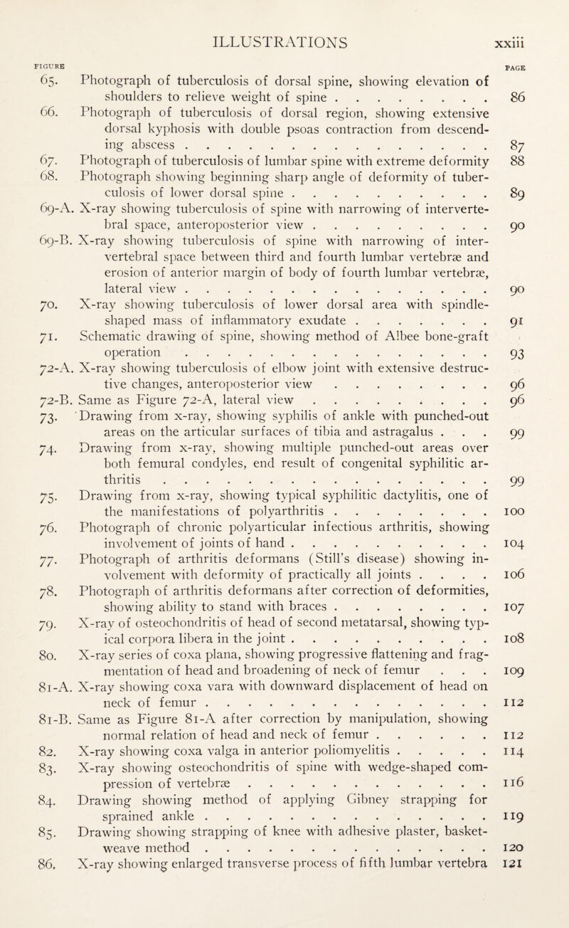 FIGURE PAGE 65. Photograph of tuberculosis of dorsal spine, showing elevation of shoulders to relieve weight of spine.86 66. Photograph of tuberculosis of dorsal region, showing extensive dorsal kyphosis with double psoas contraction from descend¬ ing abscess.87 67. Photograph of tuberculosis of lumbar spine with extreme deformity 88 68. Photograph showing beginning sharp angle of deformity of tuber¬ culosis of lower dorsal spine.89 69-A. X-ray showing tuberculosis of spine with narrowing of interverte¬ bral space, anteroposterior view.90 69-B. X-ray showing tuberculosis of spine with narrowing of inter¬ vertebral space between third and fourth lumbar vertebrae and erosion of anterior margin of body of fourth lumbar vertebrae, lateral view.90 70. X-ray showing tuberculosis of lower dorsal area with spindle- shaped mass of inflammatory exudate.91 71. Schematic drawing of spine, showing method of Albee bone-graft operation. 93 72-A. X-ray showing tuberculosis of elbow joint with extensive destruc¬ tive changes, anteroposterior view ........ 96 72-B. Same as Figure 72-A, lateral view ......... 96 73. Drawing from x-ray, showing syphilis of ankle with punched-out areas on the articular surfaces of tibia and astragalus ... 99 74. Drawing from x-ray, showing multiple punched-out areas over both femural condyles, end result of congenital syphilitic ar¬ thritis .99 75. Drawing from x-ray, showing typical syphilitic dactylitis, one of the manifestations of polyarthritis.100 76. Photograph of chronic polyarticular infectious arthritis, showing involvement of joints of hand.104 77. Photograph of arthritis deformans (Still’s disease) showing in¬ volvement with deformity of practically all joints . . . . 106 78. Photograph of arthritis deformans after correction of deformities, showing ability to stand with braces.107 79. X-ray of osteochondritis of head of second metatarsal, showing typ¬ ical corpora libera in the joint.108 80. X-ray series of coxa plana, showing progressive flattening and frag¬ mentation of head and broadening of neck of femur . . . 109 81-A. X-ray showing coxa vara with downward displacement of head on neck of femur.112 81-B. Same as Figure 81-A after correction by manipulation, showing normal relation of head and neck of femur.112 82. X-ray showing coxa valga in anterior poliomyelitis.114 83. X-ray showing osteochondritis of spine with wedge-shaped com¬ pression of vertebrae.116 84. Drawing showing method of applying Gibney strapping for sprained ankle.119 85. Drawing showing strapping of knee with adhesive plaster, basket- weave method. 120 86. X-ray showing enlarged transverse process of fifth lumbar vertebra 12X