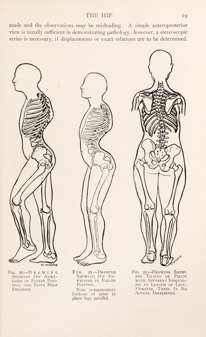 made and the observations may be misleading. A simple anteroposterior view is usually sufficient in demonstrating pathology; however, a stereoscopic series is necessary, if displacements or exact relations are to be determined. Fig. 20.—D rawing Showing Hip Anky- losed in Flexed Posi¬ tion, the Spine Held Straight. Fig. 21.—Drawing Showing Hip An- KYLOSED IN FLEXED Position. Note compensatory lordosis of spine to place legs parallel. Fig. 22.—Drawing Show¬ ing Tilting of Pelvis with Apparent Inequal¬ ity in Length of Legs ; However, There Is No Actual Difference.