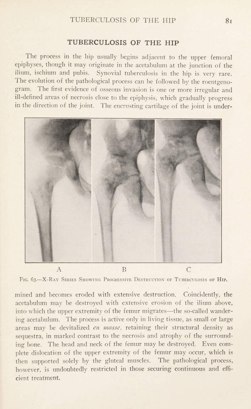 TUBERCULOSIS OF THE HIP I he process in the hip usually begins adjacent to the upper femoral epiphyses, though it may originate in the acetabulum at the junction of the ilium, ischium and pubis. Synovial tuberculosis in the hip is very rare. I he evolution of the pathological process can be followed by the roentgeno¬ gram. 1 he first evidence of osseous invasion is one or more irregular and ill-defined areas of necrosis close to the epiphysis, which gradually progress in the direction of the joint. The encrusting cartilage of the joint is under- A B C Fig. 63.—X-Ray Series Showing Progressive Destruction of Tuberculosis of Hip. mined and becomes eroded with extensive destruction. Coincidently, the acetabulum may be destroyed with extensive erosion of the ilium above, into which the upper extremity of the femur migrates—the so-called wander¬ ing acetabulum. The process is active only in living tissue, as small or large areas may be devitalized en masse, retaining their structural density as sequestra, in marked contrast to the necrosis and atrophy of the surround¬ ing bone. The head and neck of the femur may be destroyed. Even com¬ plete dislocation of the upper extremity of the femur may occur, which is then supported solely by the gluteal muscles. The pathological process, however, is undoubtedly restricted in those securing continuous and effi¬ cient treatment.