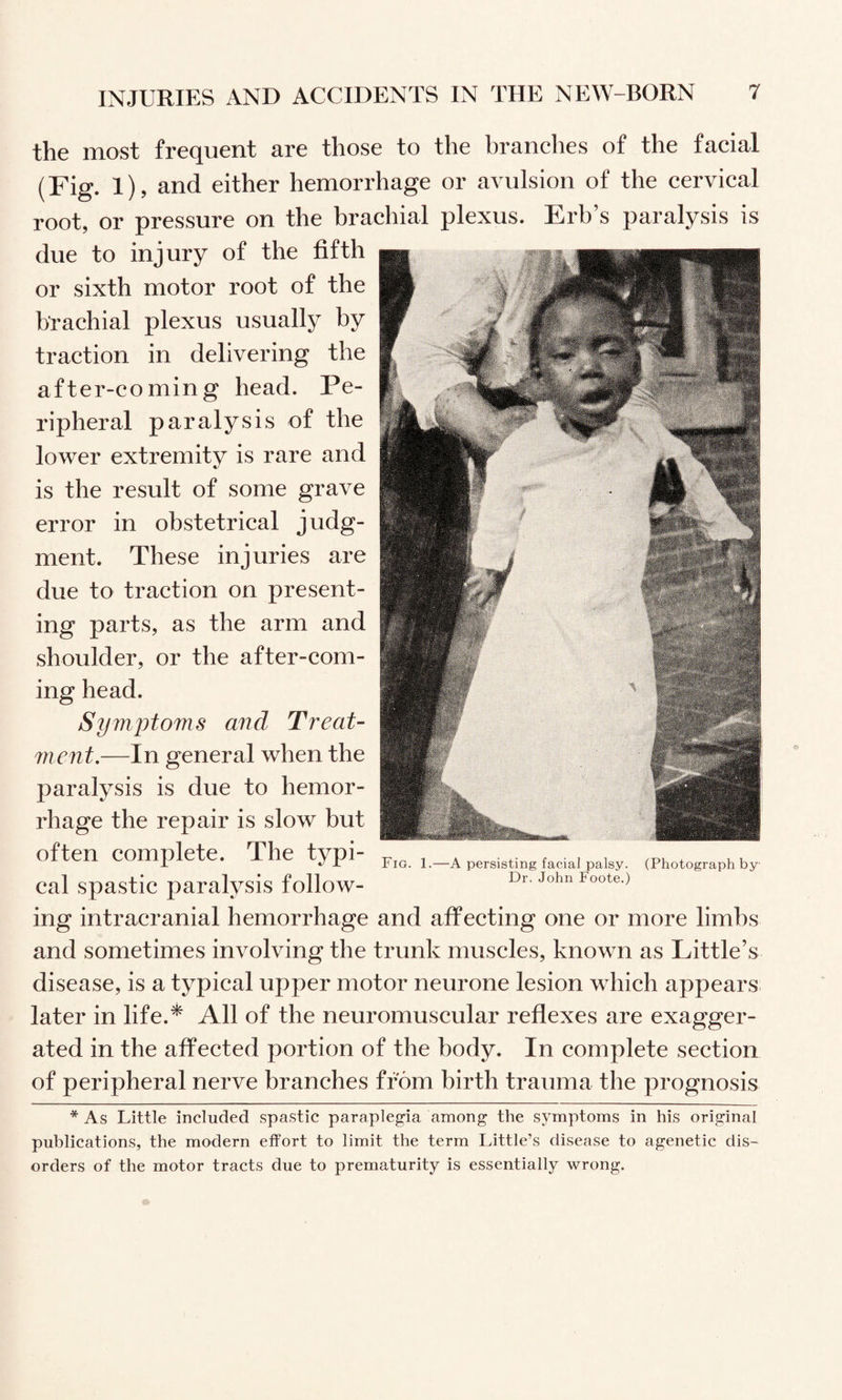 the most frequent are those to the branches of the facial (Fig. 1), and either hemorrhage or avulsion of the cervical root, or pressure on the brachial plexus. Erb’s paralysis is due to injury of the fifth or sixth motor root of the brachial plexus usually by traction in delivering the after-coming head. Pe¬ ripheral paralysis of the lower extremity is rare and is the result of some grave error in obstetrical judg¬ ment. These injuries are due to traction on present¬ ing parts, as the arm and shoulder, or the after-com¬ ing head. Symptoms and Treat¬ ment,—In general when the paralysis is due to hemor¬ rhage the repair is slow but often complete. The typi¬ cal spastic paralysis follow¬ ing intracranial hemorrhage and affecting one or more limbs and sometimes involving the trunk muscles, known as Little’s disease, is a typical upper motor neurone lesion which appears later in life.* All of the neuromuscular reflexes are exagger¬ ated in the affected portion of the body. In complete section of peripheral nerve branches from birth trauma the prognosis Fig. 1.—A persisting facial palsy. (Photograph by Dr. John Foote.) * As Little included spastic paraplegia among the symptoms in his original publications, the modern effort to limit the term Little’s disease to agenetic dis¬ orders of the motor tracts due to prematurity is essentially wrong.