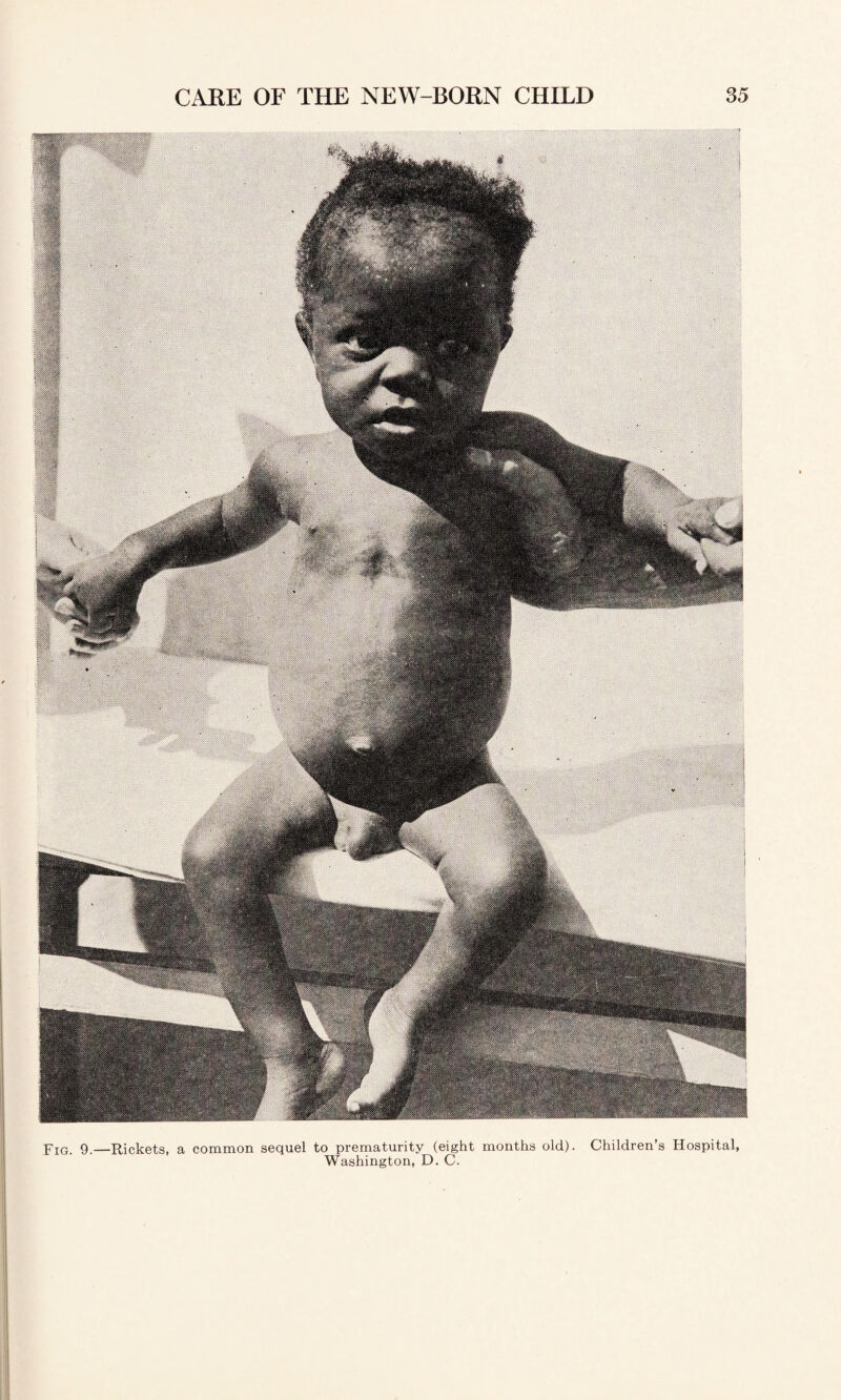 Yig. 9.—Rickets, a common sequel to prematurity (eight months old). Children’s Hospital Washington, D. C.