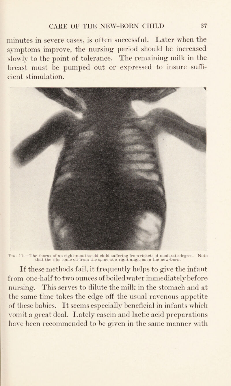 minutes in severe cases, is often successful. Later when the symptoms improve, the nursing period should be increased slowly to the point of tolerance. The remaining milk in the breast must he pumped out or expressed to insure suffi¬ cient stimulation. Fig. 11.—^The thorax of an eight-months-old child suffering from rickets of moderate degree. Note that the ribs come off from the spine at a right angle as in the new-born. If these methods fail, it frequently helps to give the infant from one-half to two ounces of boiled water immediately before nursing. This serves to dilute the milk in the stomach and at the same time takes the edge off the usual ravenous appetite of these babies. It seems especially beneficial in infants which vomit a great deal. Lately casein and lactic acid preparations have been recommended to be given in the same manner with