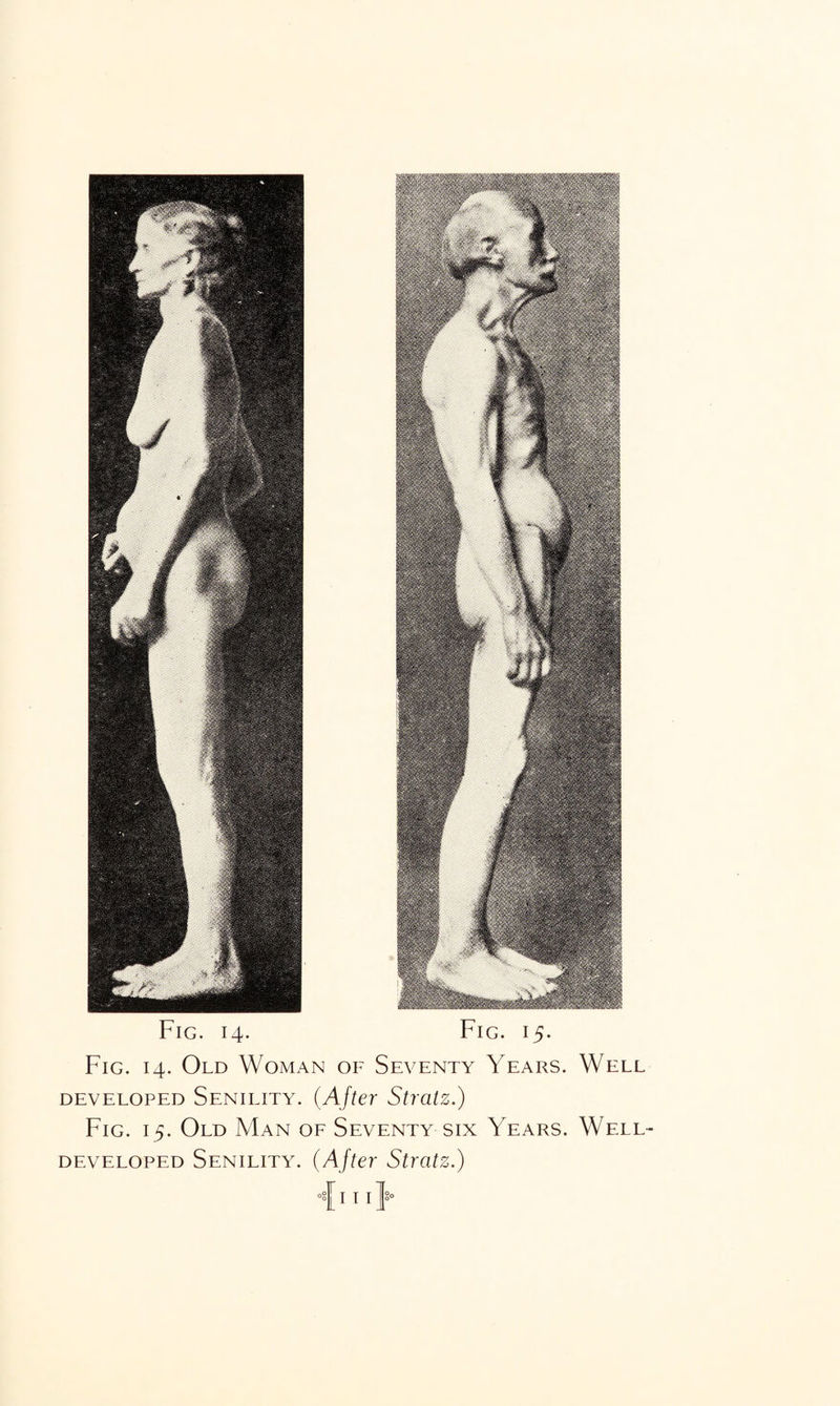 Fig. 14. Fig. 15. Fig. 14. Old Woman of Seventy Years. Well developed Senility. (After Stratz.) Fig. 15. Old Man of Seventy six Years. Well- developed Senility. (After Stratz.) •{in