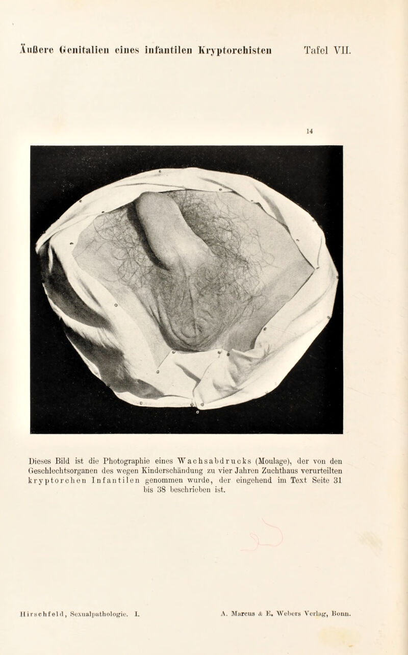 •• 14 Dieses Bild ist die Photographie eines Wachsab drucks (Moulage), der von den Geschlechtsorganen des wegen Kinderschändung zu vier Jahren Zuchthaus verurteilten kryptorchen Infantilen genommen wurde, der eingehend im Text Seite 31 bis 38 beschrieben ist.