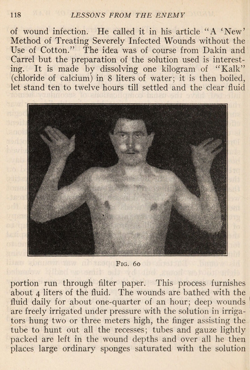 of wound infection. He called it in his article “A ‘New’ Method of Treating Severely Infected Wounds without the Use of Cotton.” The idea was of course from Dakin and Carrel but the preparation of the solution used is interest¬ ing. It is made by dissolving one kilogram of “Kalk” (chloride of calcium) in 8 liters of water; it is then boiled, let stand ten to twelve hours till settled and the clear fluid Fig. 6o portion run through filter paper. This process furnishes about 4 liters of the fluid. The wounds are bathed with the fluid daily for about one-quarter of an hour; deep wounds are freely irrigated under pressure with the solution in irriga¬ tors hung two or three meters high, the finger assisting the tube to hunt out all the recesses; tubes and gauze lightly packed are left in the wound depths and over all he then places large ordinary sponges saturated with the solution