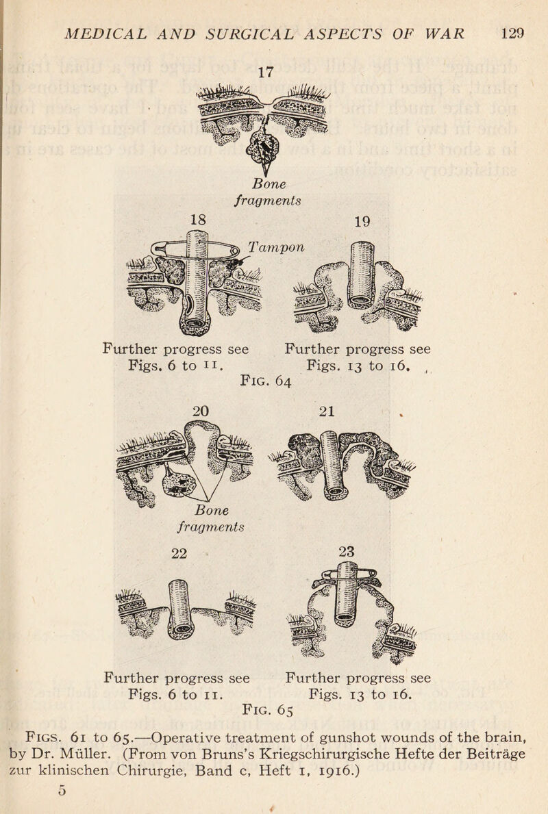 17 18 19 Further progress see Further progress see Figs. 6 to ii. Figs. 13 to 16. ( Fig. 64 20 21 Further progress see Further progress see Figs. 6 to 11. Figs. 13 to 16. Fig. 65 Figs. 61 to 65.—Operative treatment of gunshot wounds of the brain, by Dr. Muller. (From von Bruns’s Kriegschirurgische Hefte der Beitrage zur klinischen Chirurgie, Band c, Heft i, 1916.)