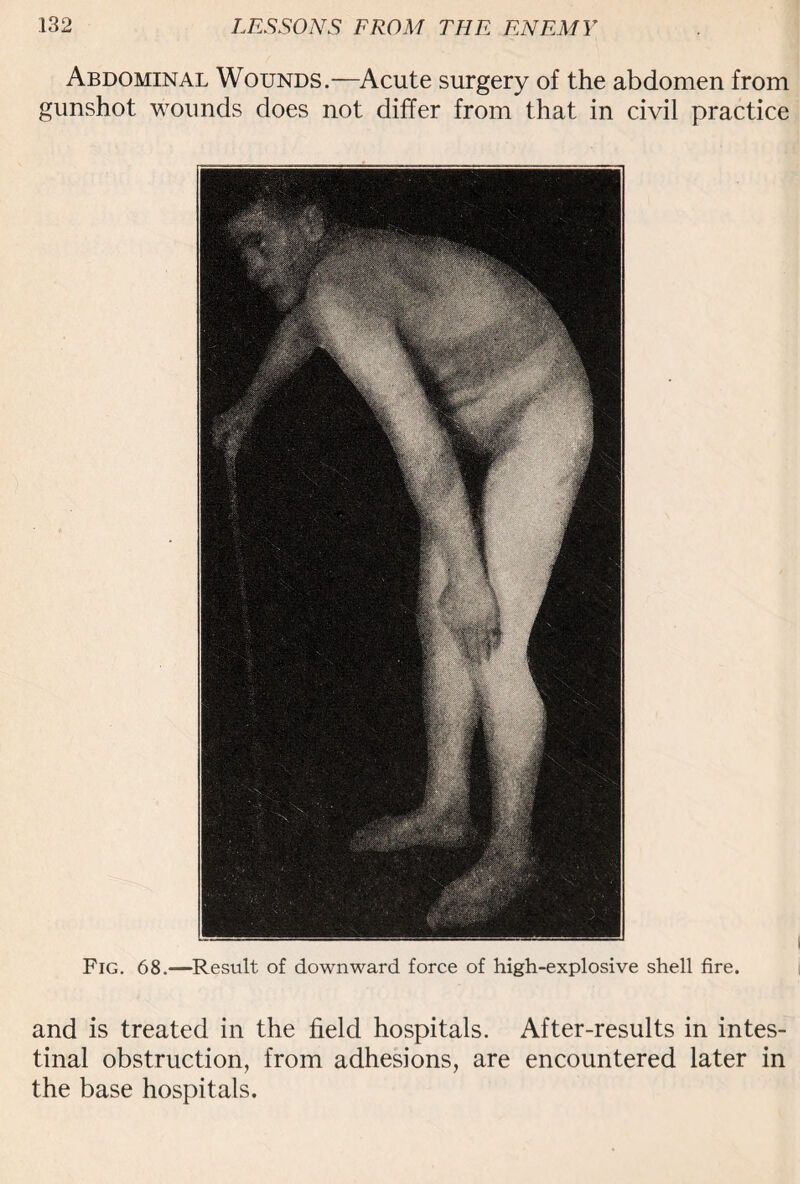 Abdominal Wounds.—Acute surgery of the abdomen from gunshot wounds does not differ from that in civil practice Fig. 68.—Result of downward force of high-explosive shell fire. and is treated in the field hospitals. After-results in intes¬ tinal obstruction, from adhesions, are encountered later in the base hospitals.