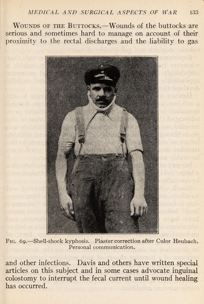 Fig. 69.—Shell-shock kyphosis. Plaster correction after Culor Heubach. Personal communication. and other infections. Davis and others have written special articles on this subject and in some cases advocate inguinal colostomy to interrupt the fecal current until wound healing has occurred. Wounds of the Buttocks.—Wounds of the buttocks are serious and sometimes hard to manage on account of their proximity to the rectal discharges and the liability to gas