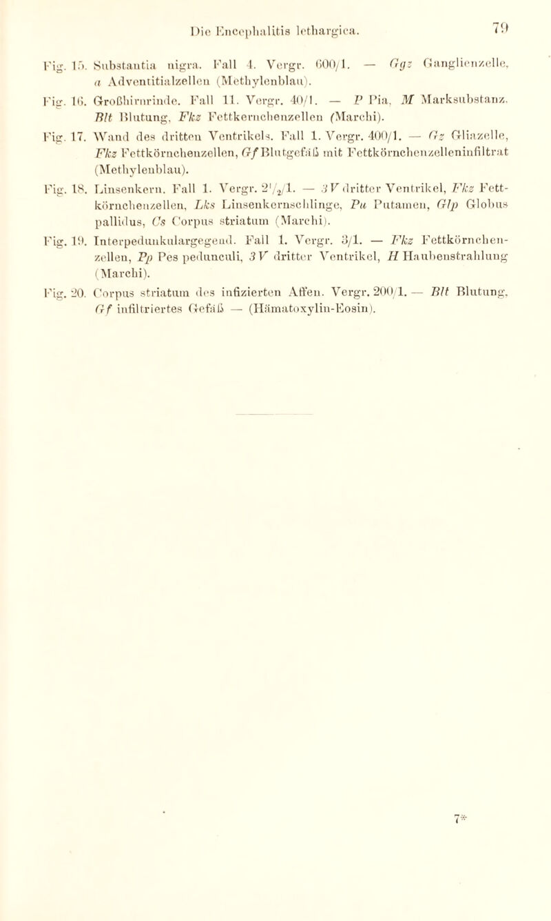 Fig. 1Substantia nigra. Fall 4. Vergr. 600/1. — Ggz Ganglienzelle, n Adventitialzellen (Methylenblau). l'ig. 16. Großhirnrinde. Fall 11. Vergr. 40/1. — P Pia, M Marksubstan/.. Bit Blutung, Fkz Fettkernchenzellen (Marchi). Fig. 17. Wand des dritten Ventrikels. Fall 1. Vergr. 400/1. — (lz Gliazelle, Fkz Fettkörnchenzellen, Gf Blutgefäß mit Fettkörnchenzelleninfiltrat (Methylenblau). Fig. 18. Linsenkern. Fall 1. Vergr. 2'/2/l. — 3V dritter Ventrikel, Fkz Fe tt- körnchenzellen, Lks Linsenkernschlinge, Pu Putamen, Glp Globus pallidus, Cs Corpus striatum (Marchi). Fig. 19. Interpedunkulargegend. Fall 1. Vergr. 3/1. — Fkz Fettkörnchen¬ zellen, Pp Pes pedunculi, 3 V dritter Ventrikel, H Haubenstrahlung (Marchi). Fig. 20. Corpus striatum des infizierten Affen. Vergr. 200/1.— Bit Blutung, Gf infiltriertes Gefäß — (Hämatoxylin-Eosin). i