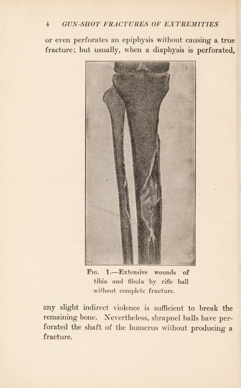 or even perforates an epiphysis without causing a true fracture; but usually, when a diaphysis is perforated, Fig. 1.—Extensive wounds of tibia and fibula by rifle ball without complete fracture. any slight indirect violence is sufficient to break the remaining bone. Nevertheless, shrapnel balls have per¬ forated the shaft of the humerus without producing a fracture.