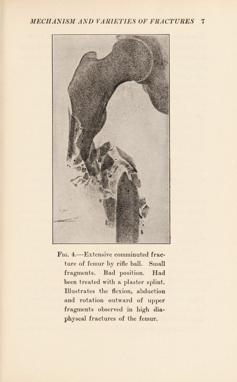 Fig. 4.—Extensive comminuted frac¬ ture of femur by rifle ball. Small fragments. Bad position. Had been treated with a plaster splint. Illustrates the flexion, abduction and rotation outward of upper fragments observed in high dia¬ physeal fractures of the femur.