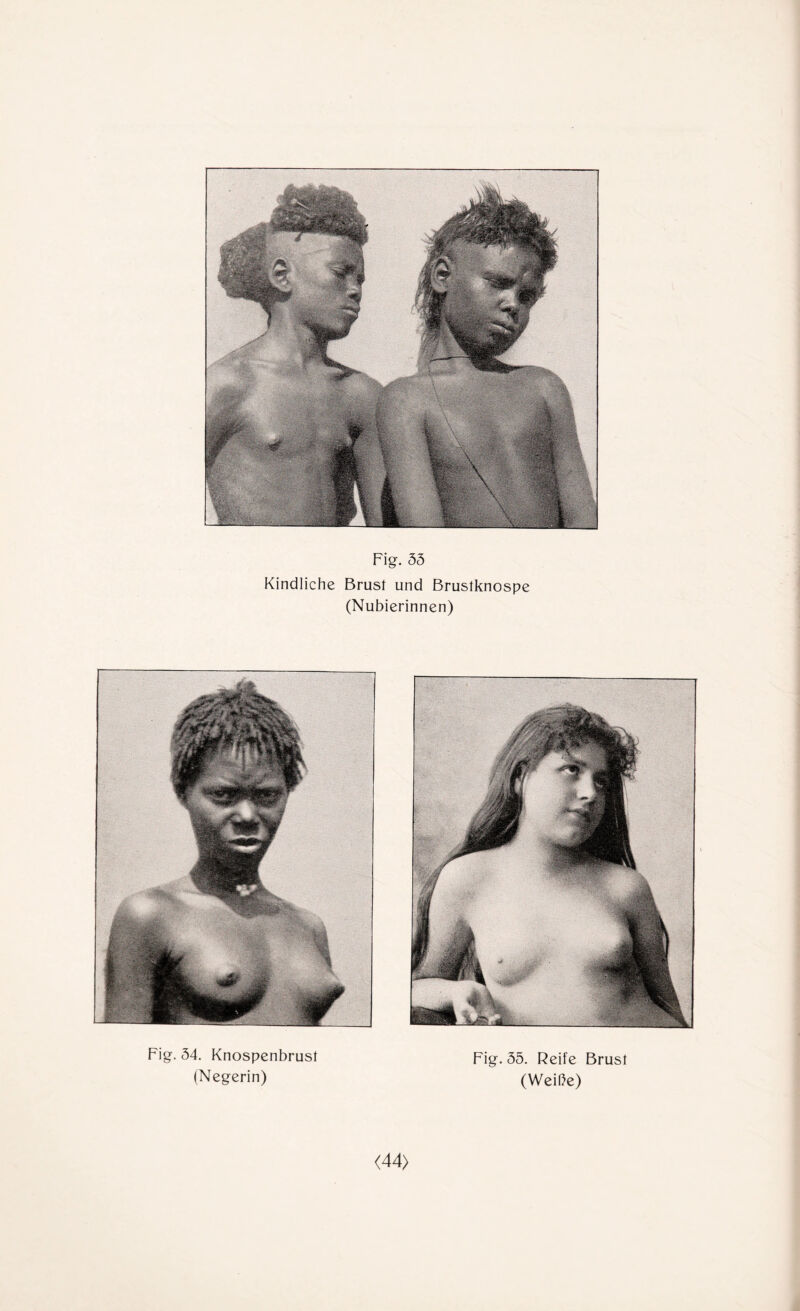 Fig. 33 Kindliche Brust und Brustknospe (Nubierinnen) Fig. 34. Knospenbrust Fig. 35. Reife Brust (Negerin) (Weibe) <44>