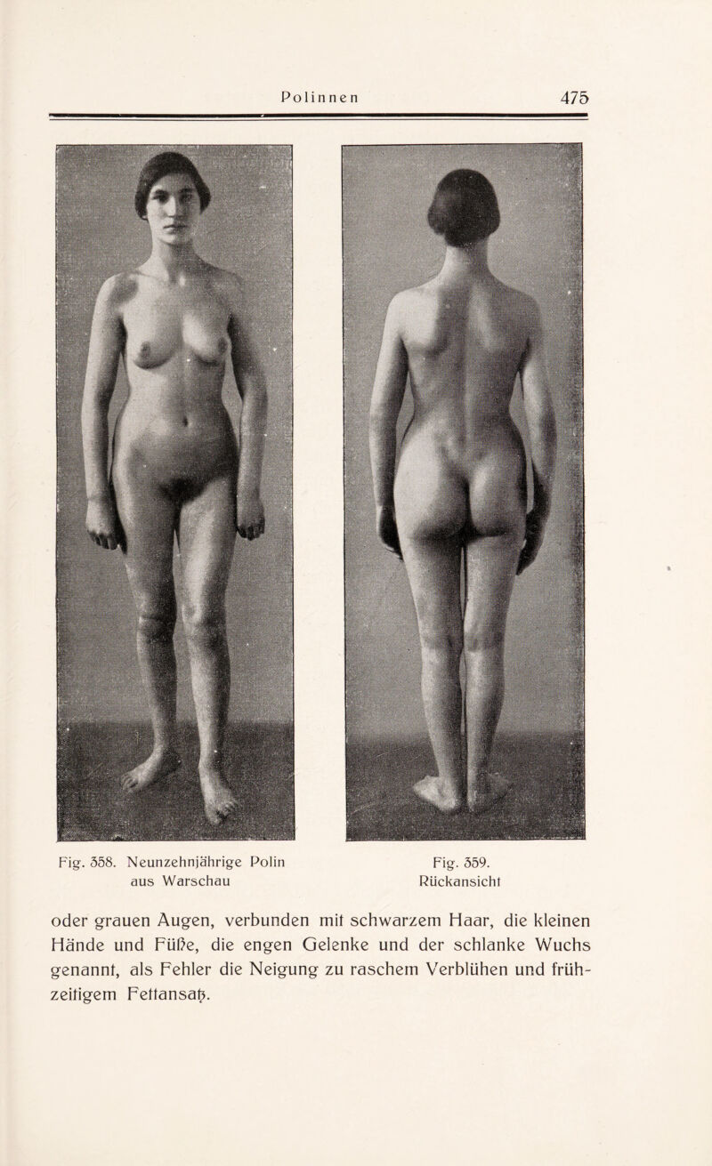 Fig. 558. Neunzehnjährige Polin Fig. 559. aus Warschau Rückansicht oder grauen Augen, verbunden mit schwarzem Haar, die kleinen Hände und Füße, die engen Gelenke und der schlanke Wuchs genannt, als Fehler die Neigung zu raschem Verblühen und früh¬ zeitigem Fettansatz