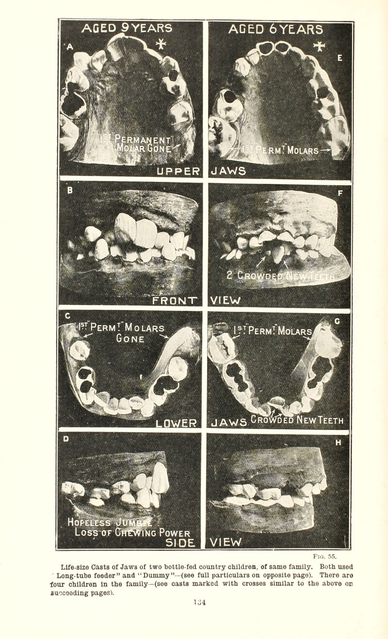 AGED 9 YEARS ERMANENT'i (I OMR GON E< Perm! Molars, Hopeless d< Fia. 55. Life-size Casts of Jaws of two bottle-fed. country children, of same family. Both used Long-tube feeder” and “Dummy (see full particulars on opposite page). There are four children in the family—(see casts marked with crosses similar to the above on succeeding pages'). 134 UPPER □WER Loss of CtfEWitoG Power SIDE