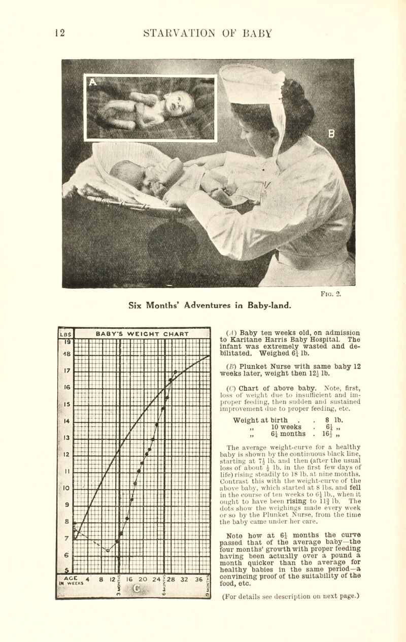 Six Months’ Adventures in Baby-land. Fig. 2. (.1) Baby ten weeks old, on admission to Karitane Harris Baby Hospital. The infant was extremely wasted and de¬ bilitated. Weighed 6} lb. (B) Plunket Nurse with same baby 12 weeks later, weight then 12J lb. (C) Chart of above baby. Note, first, loss of weight due to insufficient and im¬ proper feeding, then sudden and sustained improvement due to proper feeding, etc. Weight at birth . . 8 lb. „ 10 weeks . 6} „ „ 6} months . 16? „ The average weight-curve for a healthy baby is shown by the continuous black line, starting at 71 lb. and then (after the usual loss of about J lb. in the first few days of life) rising steadily to 18 lb. at nine months. Contrast this with the weight-curve of the above baby, which started at S lbs. and feU in the course of ten weeks to 6J lb., when it ought to have been rising to 11J lb. The dots show the weighings made every week or so by the Plunket Nurse, from the time the baby came under her care. Note how at 6} months the curve passed that of the average baby—the four months’ growth with proper feeding having been actually over a pound a month quicker than the average for healthy babies in the same period—a convincing proof of the suitability of the food, etc. (For details see description on next page.)