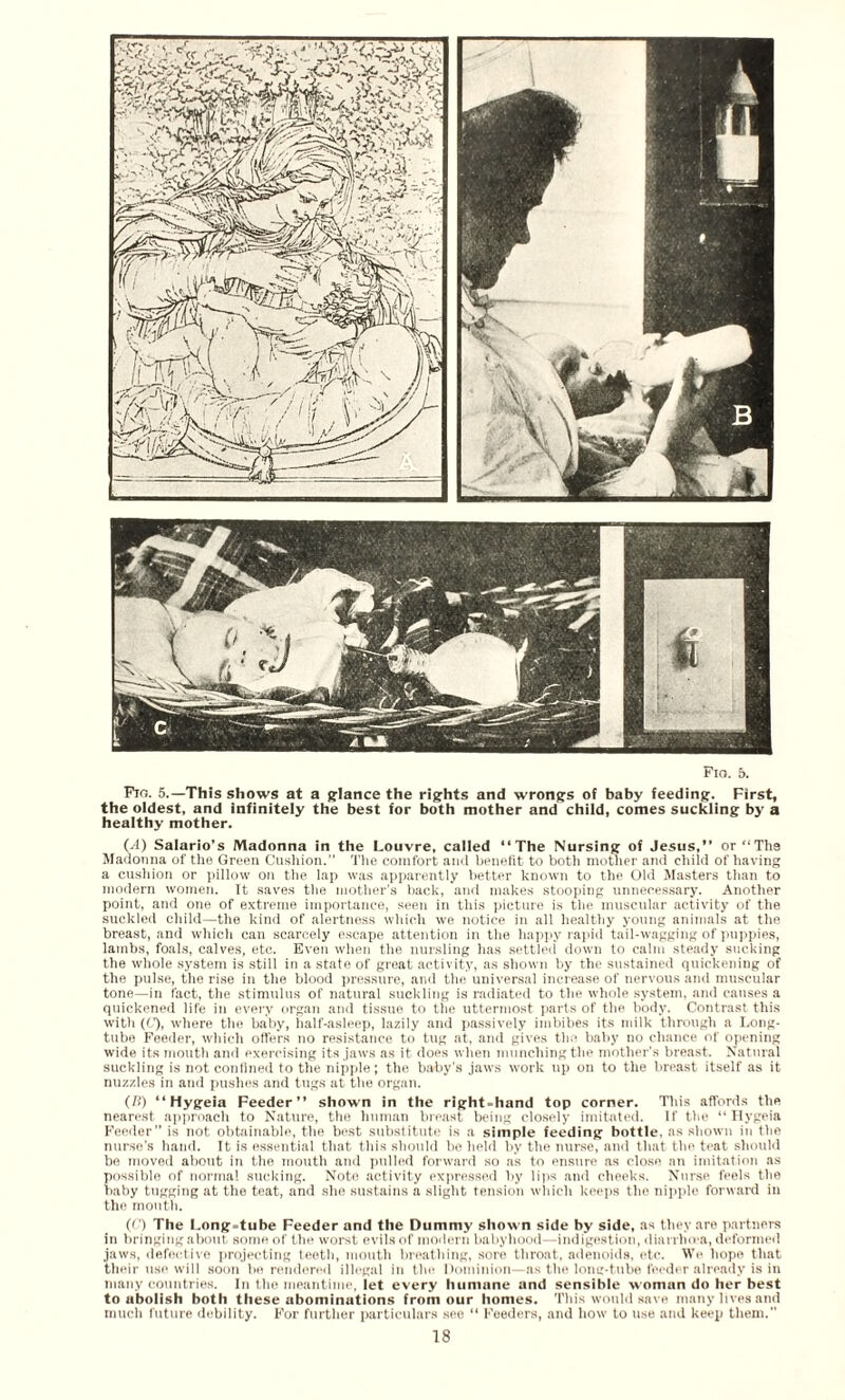 Flo. 6. Fig. 5.—This shows at a glance the rights and wrongs of baby feeding. First, the oldest, and infinitely the best for both mother and child, comes suckling by a healthy mother. (.4) Salario’s Madonna in the Louvre, called ‘‘The Nursing of Jesus,” or “Ths Madonna of the Green Cushion.” The comfort and benefit to both mother and child of having a cushion or pillow on the lap was apparently better known to the Old Masters than to modern women. It saves the mother’s back, and makes stooping unnecessary. Another point, and one of extreme importance, seen in this picture is the muscular activity of the suckled child—the kind of alertness which we notice in all healthy young animals at the breast, and which can scarcely escape attention in the happy rapid tail-wagging of puppies, lambs, foals, calves, etc. Even when the nursling has settled down to calm steady sucking the whole system is still in a state of great activity, as shown by the sustained quickening of the pulse, the rise in the blood pressure, and the universal increase of nervous and muscular tone—in fact, the stimulus of natural suckling is radiated to the whole system, and causes a quickened life in every organ and tissue to the uttermost parts of the body. Contrast this with (C), where the baby, half-asleep, lazily and passively imbibes its milk through a Long- tube Feeder, which offers no resistance to tug at, and gives the baby no chance of opening wide its month and exercising its jaws as it does when munching the mother's breast. Natural suckling is not confined to the nipple; the baby's jaws work up on to the breast itself as it nuzzles in and pushes and tugs at the organ. (/I) ‘‘Hygeia Feeder” shown in the right-hand top corner. This affords the nearest approach to Nature, the human breast being closely imitated. If the ‘‘Hygeia Feeder” is not obtainable, the best substitute is a simple feeding bottle, as shown in the nurse’s hand. It is essential that this should be held by the nurse, and that the teat should be moved about in the mouth and pulled forward so as to ensure as close an imitation as possible of norma! sucking. Note activity expressed by lips and cheeks. Nurse feels the baby tugging at the teat, and she sustains a slight tension which keeps the nipple forward in the mouth. ((') The Long-tube Feeder and the Dummy shown side by side, as they are partners in bringing about some of the worst evils of modern babyhood—indigestion, diarrlnva, deformed jaws, defective projecting teeth, mouth breathing, sore throat, adenoids, etc. We hope that their use will soon be rendered illegal in the Dominion—as the long-tube feeder already is in many countries. In the meantime, let every humane and sensible woman do her best to abolish both these abominations from our homes. This would save many lives and much future debility. For further particulars see “ Feeders, and how to use and keep them.”