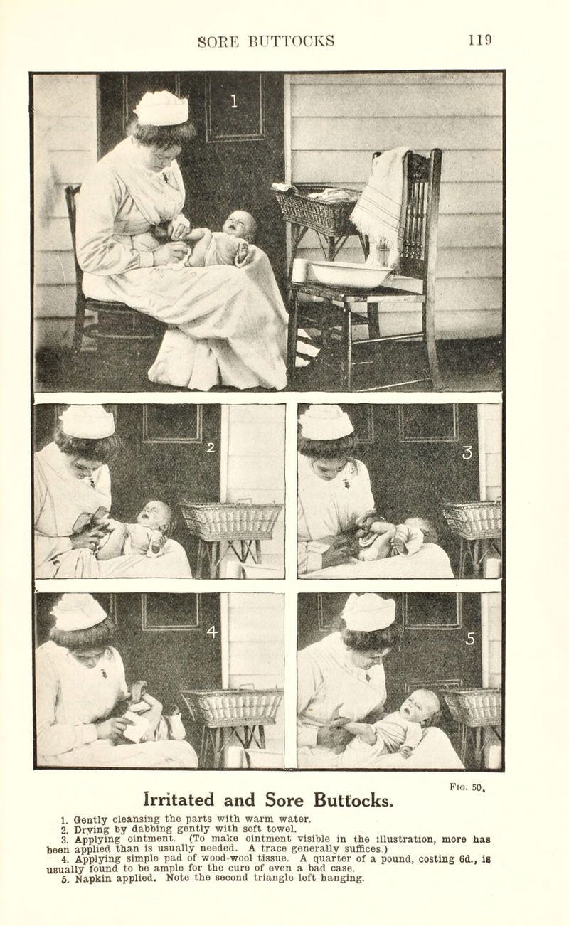SORE BUTTOCKS 110 Fio. 50. Irritated and Sore Buttocks. 1. Gently cleansing the parts with warm water. 2. Drying by dabbing gently with soft towel. 3. Applying ointment. (To make ointment visible in the illustration, more has been applied than is usually needed. A trace generally suffices ) 4. Applying simple pad of wood wool tissue. A quarter of a pound, costing 6d., is usually found to be ample for the cure of even a bad case.