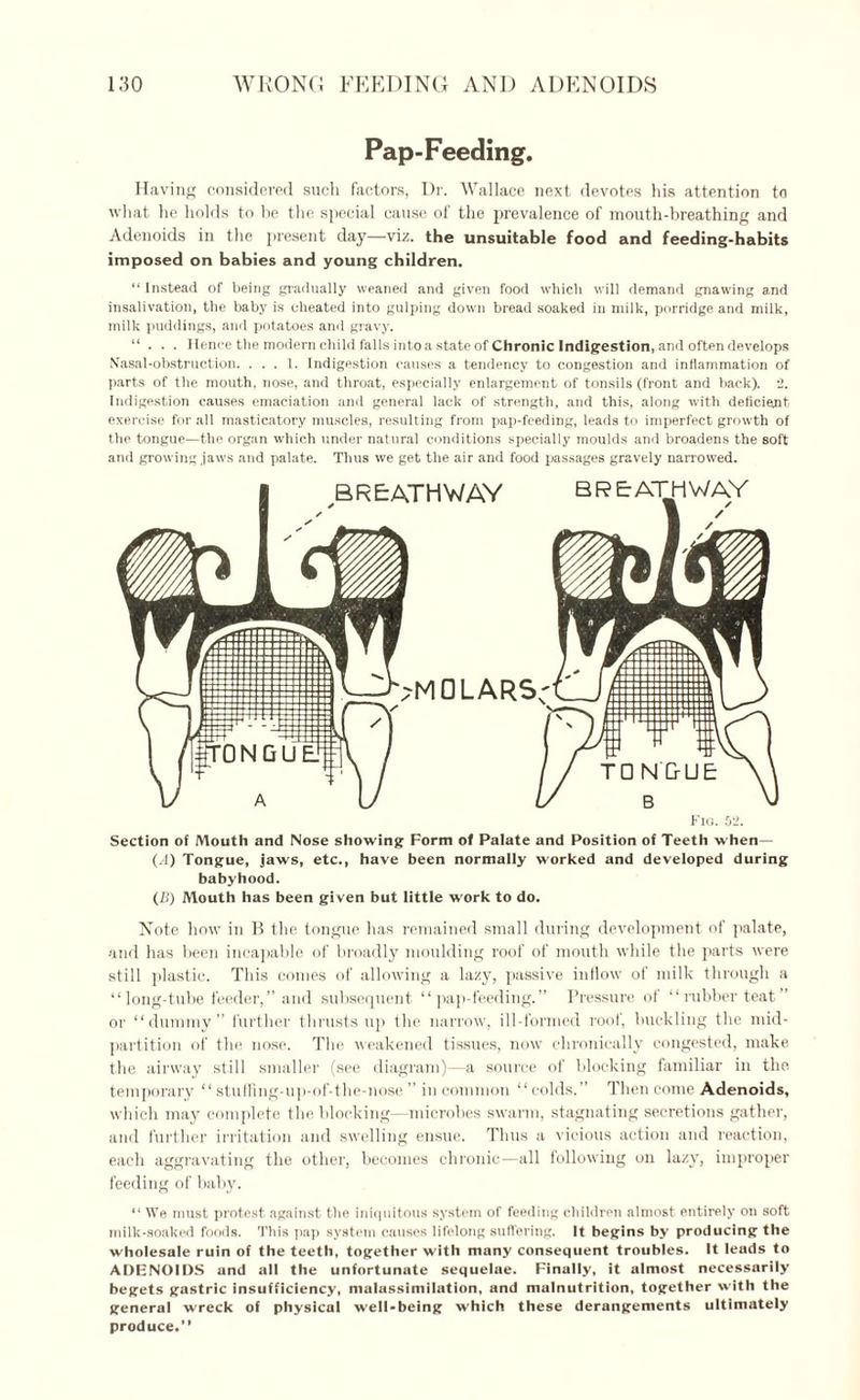Pap-Feeding. Having considered such factors, Dr. Wallace next devotes his attention to what he holds to be the special cause of the prevalence of mouth-breathing and Adenoids in the present day—viz. the unsuitable food and feeding-habits imposed on babies and young children. “ Instead of being gradually weaned and given food which will demand gnawing and insalivation, the baby is cheated into gulping down bread soaked in milk, porridge and milk, milk puddings, and potatoes and gravy. “ . . . Hence the modern child falls into a state of Chronic Indigestion, and often develops Nasal-obstruction. ... 1. Indigestion causes a tendency to congestion and inflammation of parts of the mouth, nose, and throat, especially enlargement of tonsils (front and back). 2. Indigestion causes emaciation and general lack of strength, and this, along with deficient exercise for all masticatory muscles, resulting from pap-fceding, leads to imperfect growth of the tongue—the organ which under natural conditions specially moulds and broadens the soft and growing .jaws and palate. Thus we get the air and food passages gravely narrowed. Fig. 52. Section of Mouth and Nose showing Form of Palate and Position of Teeth when— (A) Tongue, jaws, etc., have been normally worked and developed during babyhood. (£') Mouth has been given but little work to do. Note how in B the tongue lias remained small during development of palate, and has been incapable of broadly moulding roof of mouth while the parts were still plastic. This comes of allowing a lazy, passive inflow of milk through a “long-tube feeder,” and subsequent “pap-feeding.” Pressure of “rubber teat” or “dummy” further thrusts up the narrow, ill-formed roof, buckling the mid- partition of the nose. The weakened tissues, now chronically congested, make the airway still smaller (see diagram)—a source of blocking familiar in the. temporary “ stuffing-up-of-the-nose ” in common “colds.” Then come Adenoids, which may complete the blocking—microbes swarm, stagnating secretions gather, and further irritation and swelling ensue. Thus a vicious action and reaction, each aggravating the other, becomes chronic—all following on lazy, improper feeding of baby. “ We must protest against the iniquitous system of feeding children almost entirely on soft milk-soaked foods. This pap system causes lifelong suffering. It begins by producing the wholesale ruin of the teeth, together with many consequent troubles. It leads to ADENOIDS and all the unfortunate sequelae. Finally, it almost necessarily begets gastric insufficiency, malassimilation, and malnutrition, together with the general wreck of physical well-being which these derangements ultimately produce.’’