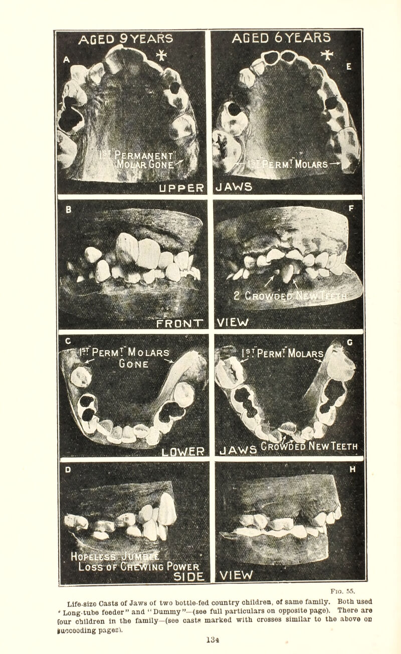 AGED 9 YEARS ERMANENT AoiiarGone^ rm! Molars AGED 6YEARS JAWS VIEW Fio. .*>5. Life-size Casts of Jaws of two bottle-fed country children, of same family. Both used ' Long-tube feeder” and “ Dummy”—(see full particulars on opposite page). There are tour children in the family—(see casts marked with crosses similar to the above on fcuocooding pages).